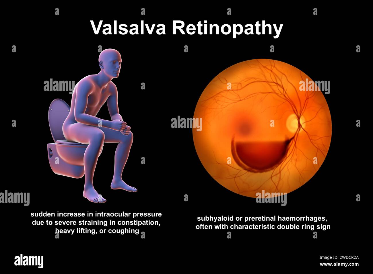 Valsava retinopathy, illustration Stock Photo