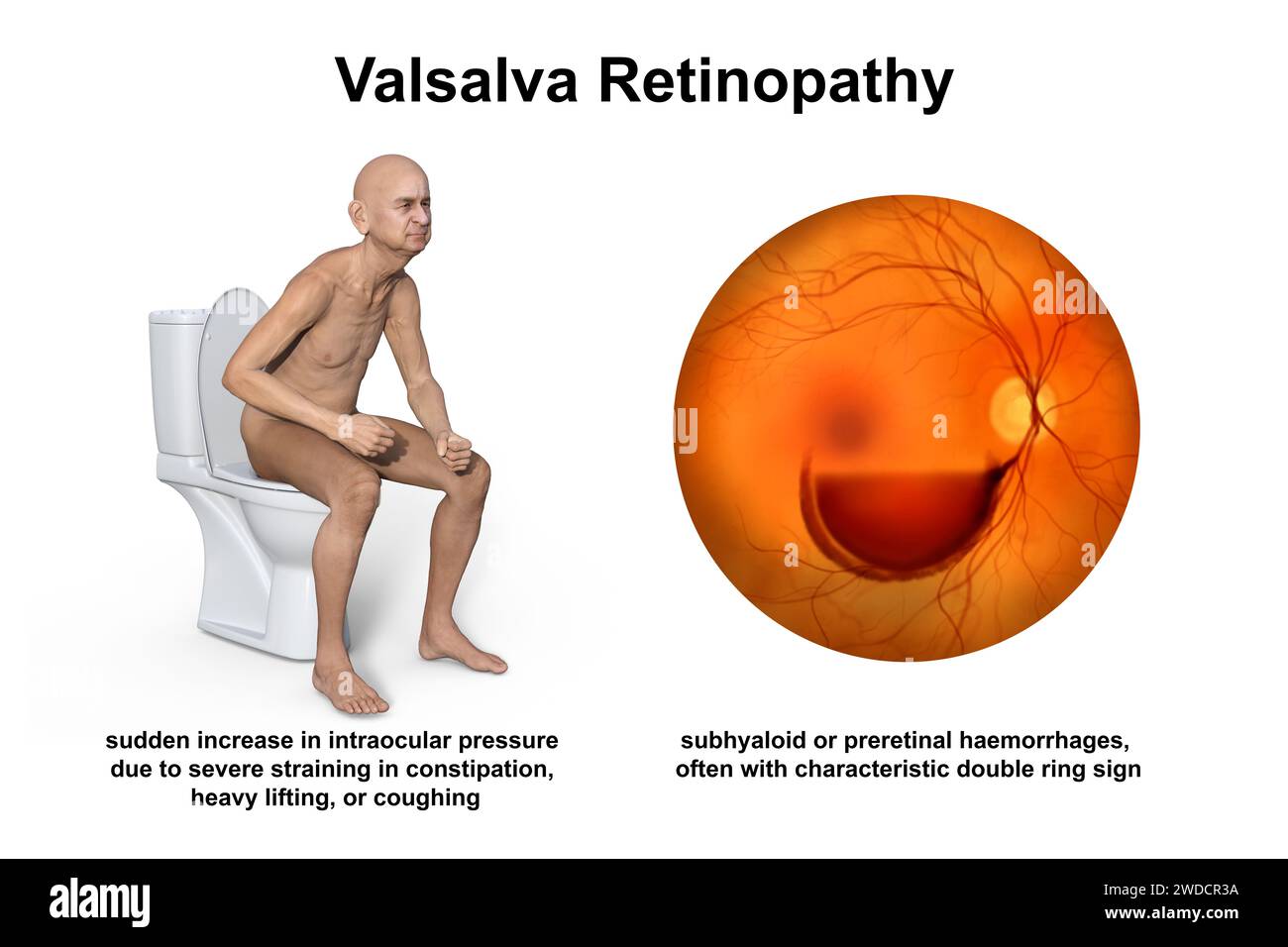 Valsava retinopathy, illustration Stock Photo