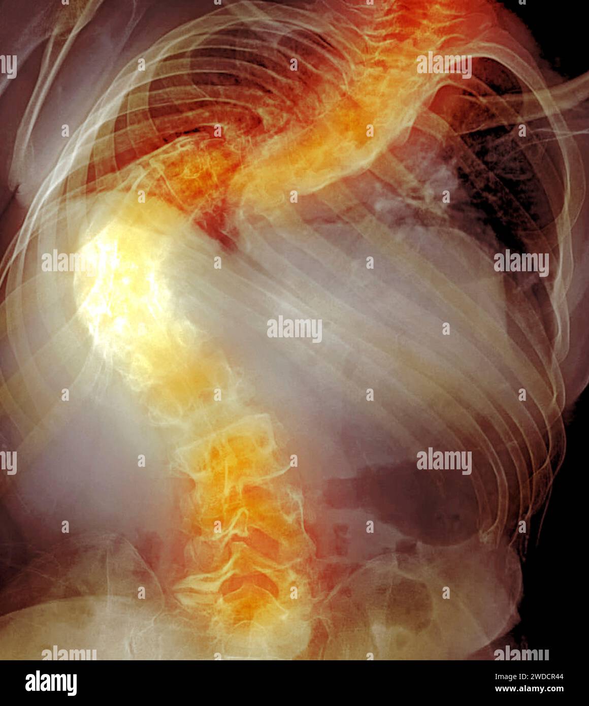 Coloured X-ray of the spine of a patient with back pain showing severe ...