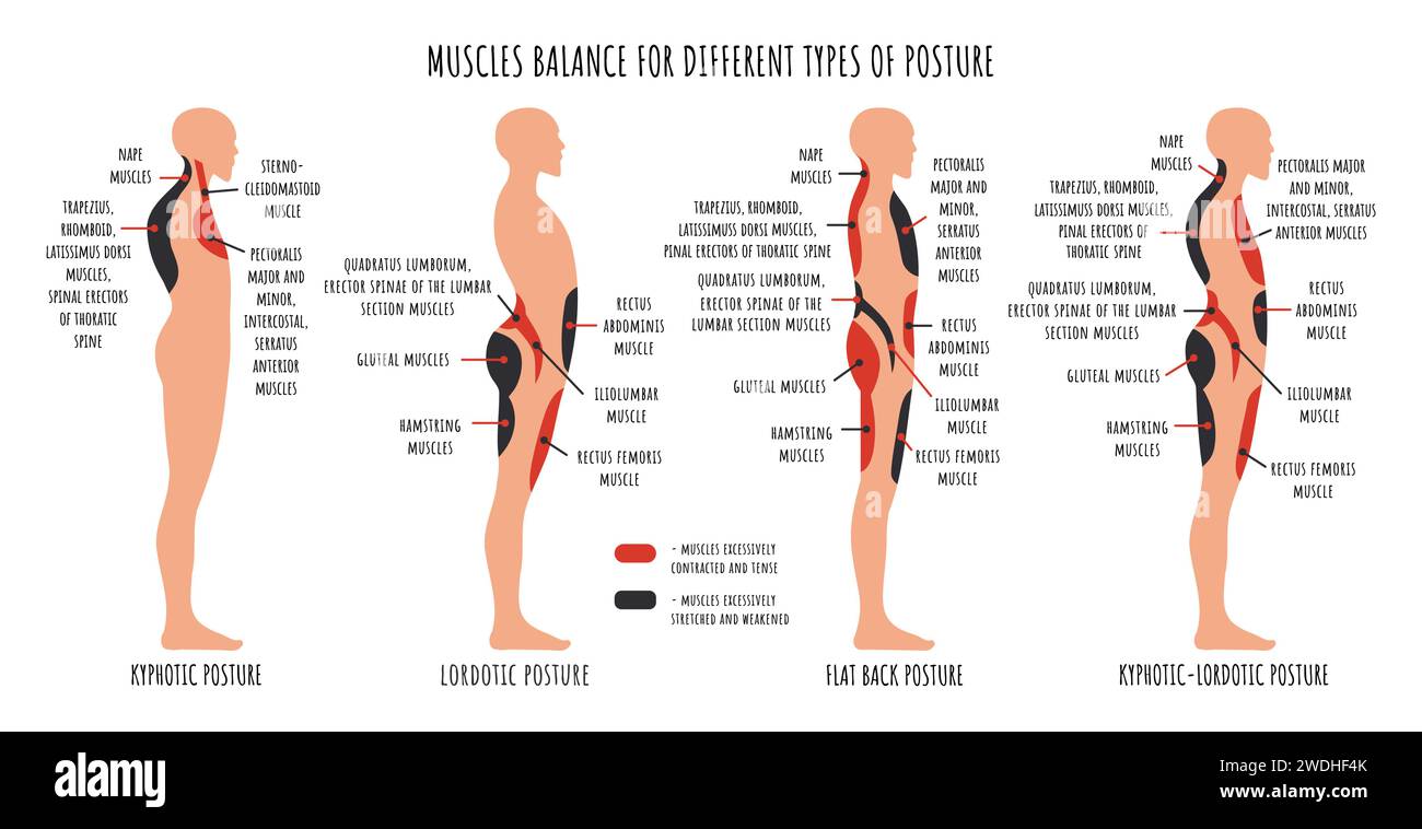 Comparison of muscle imbalance in various postural disorders Kyphotic