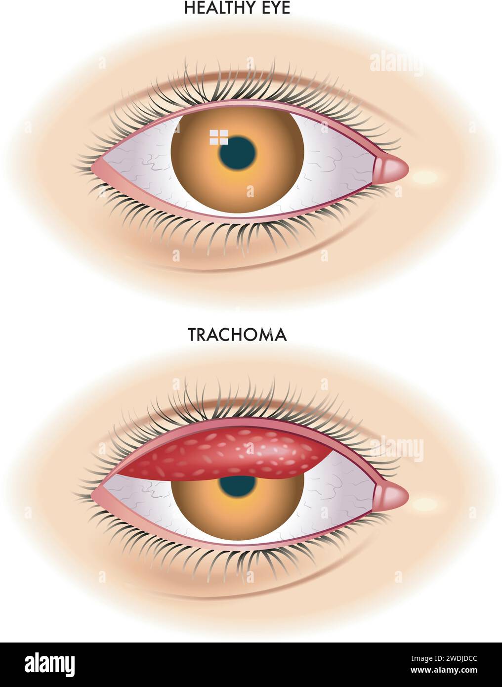 Medical illustration shows the comparison between a normal eye and one affected by trachoma an infectious disease caused by bacterium Chlamydia  trach Stock Vector