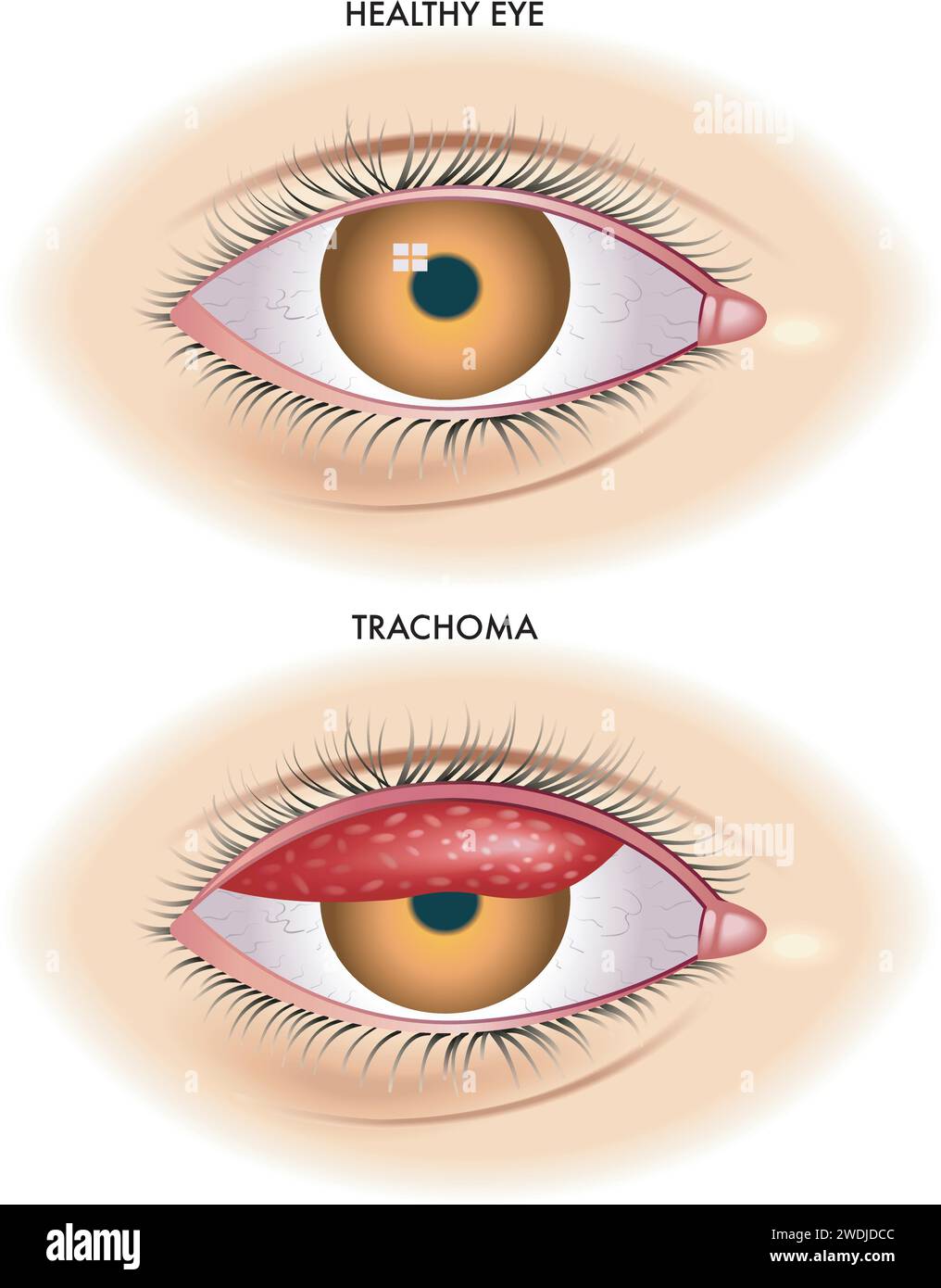 Trachomatis Stock Vector Images Alamy Trachomatis Stock Vector Images Alamy