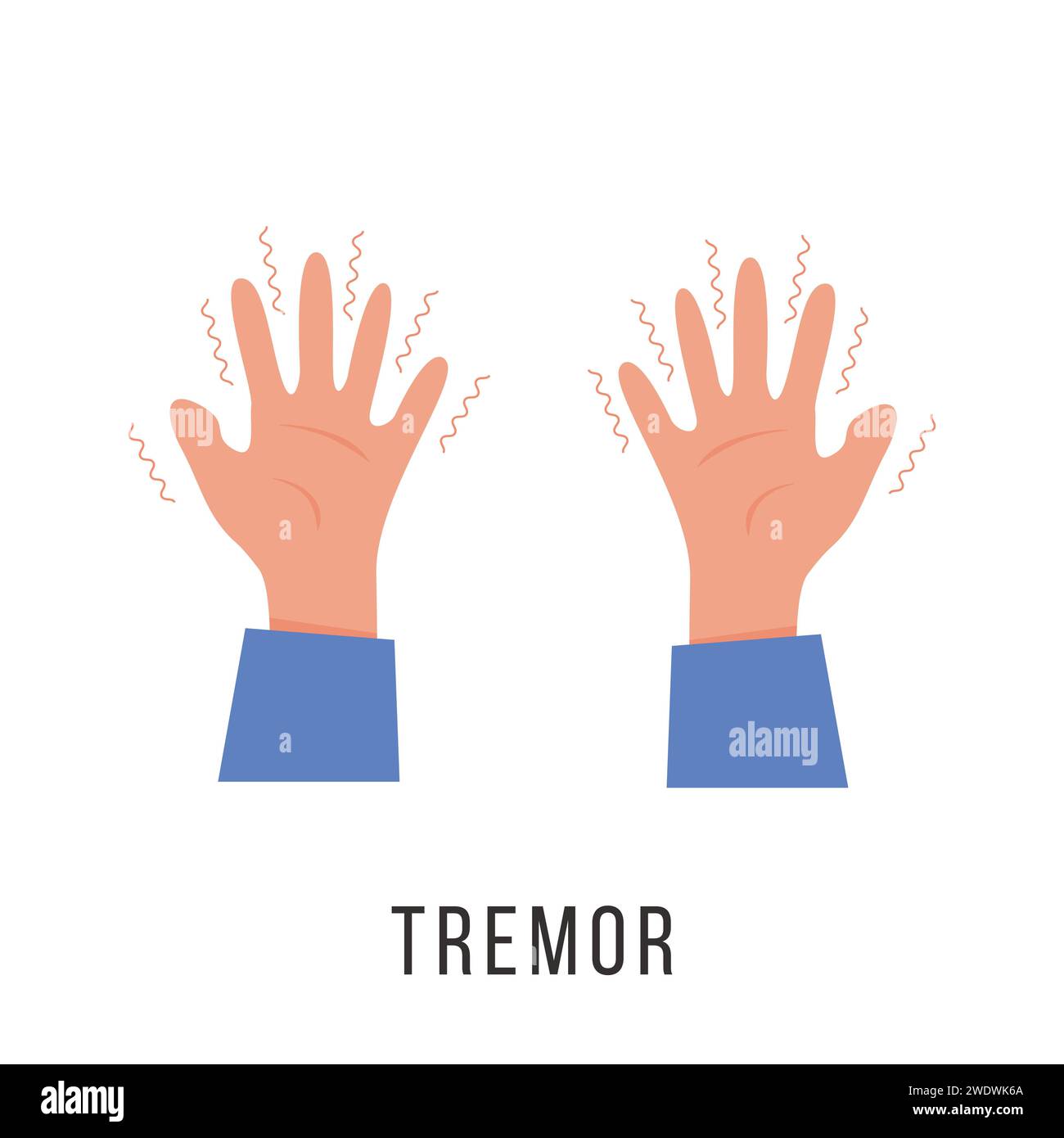Hands with tremor symptom. Parkinson disease. Trembling or Shivering arms. Physiological stress symptoms. Mental disorders, panic, fear. Vector illust Stock Vector