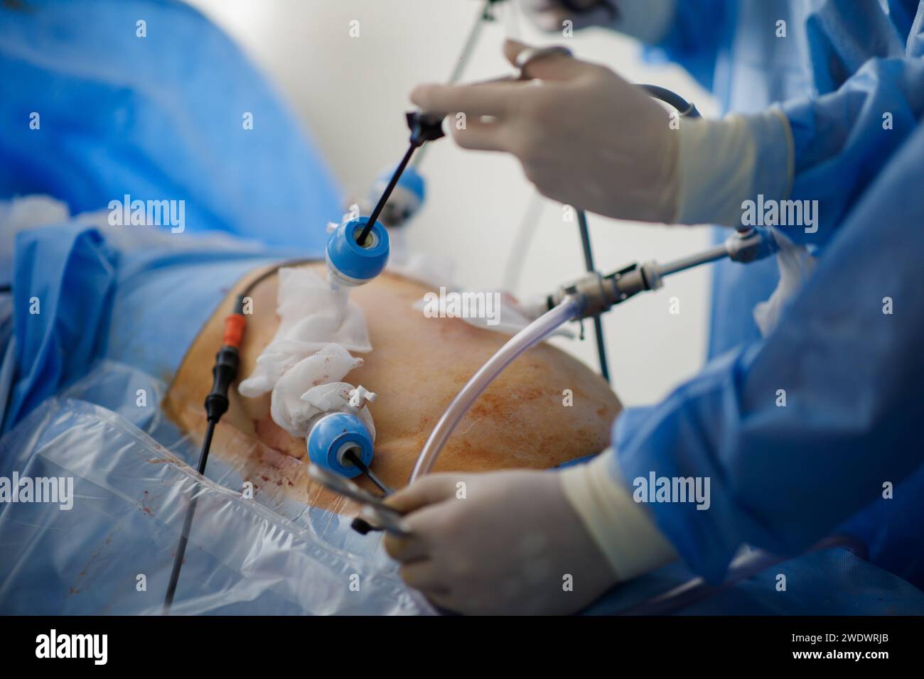 doctors perform laparoscopy operations in the intensive care unit. High quality photo Stock Photo