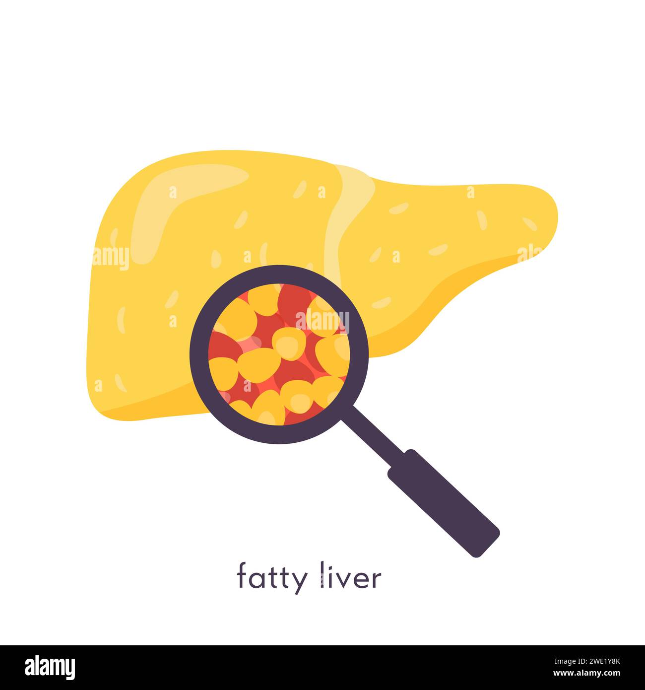 Unhealthy fatty liver. Damaged human organ under magnifying glass ...