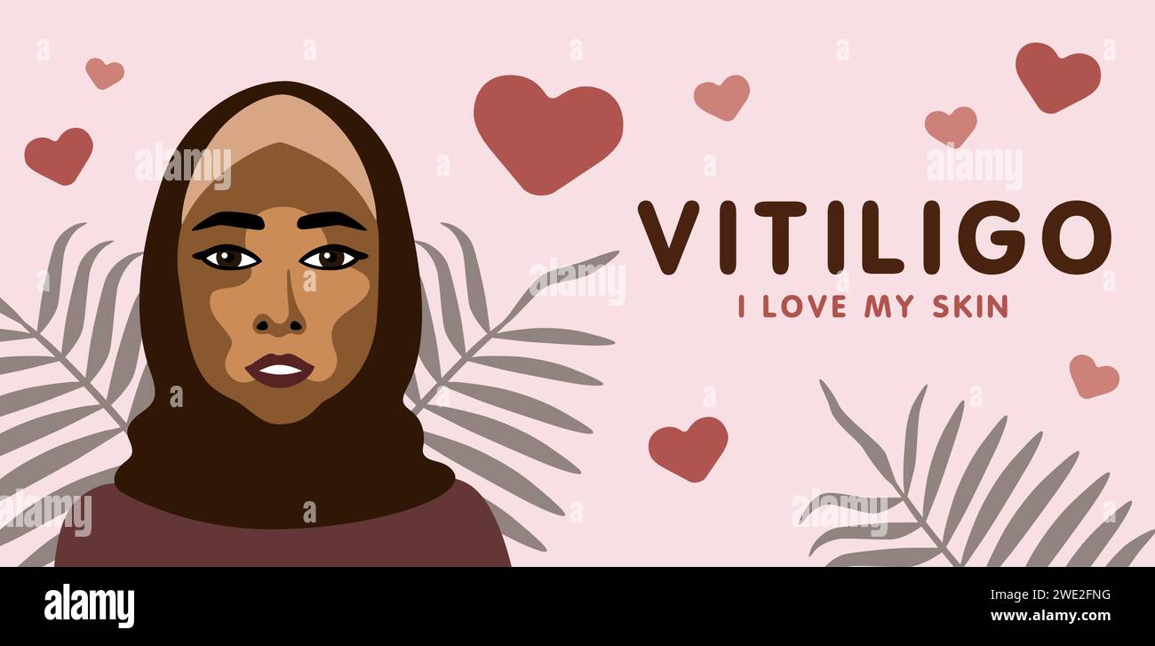 Banner about vitilingo skin disease with young beautiful Muslim woman, minimalistic vector illustration, text I love my skin Stock Vector