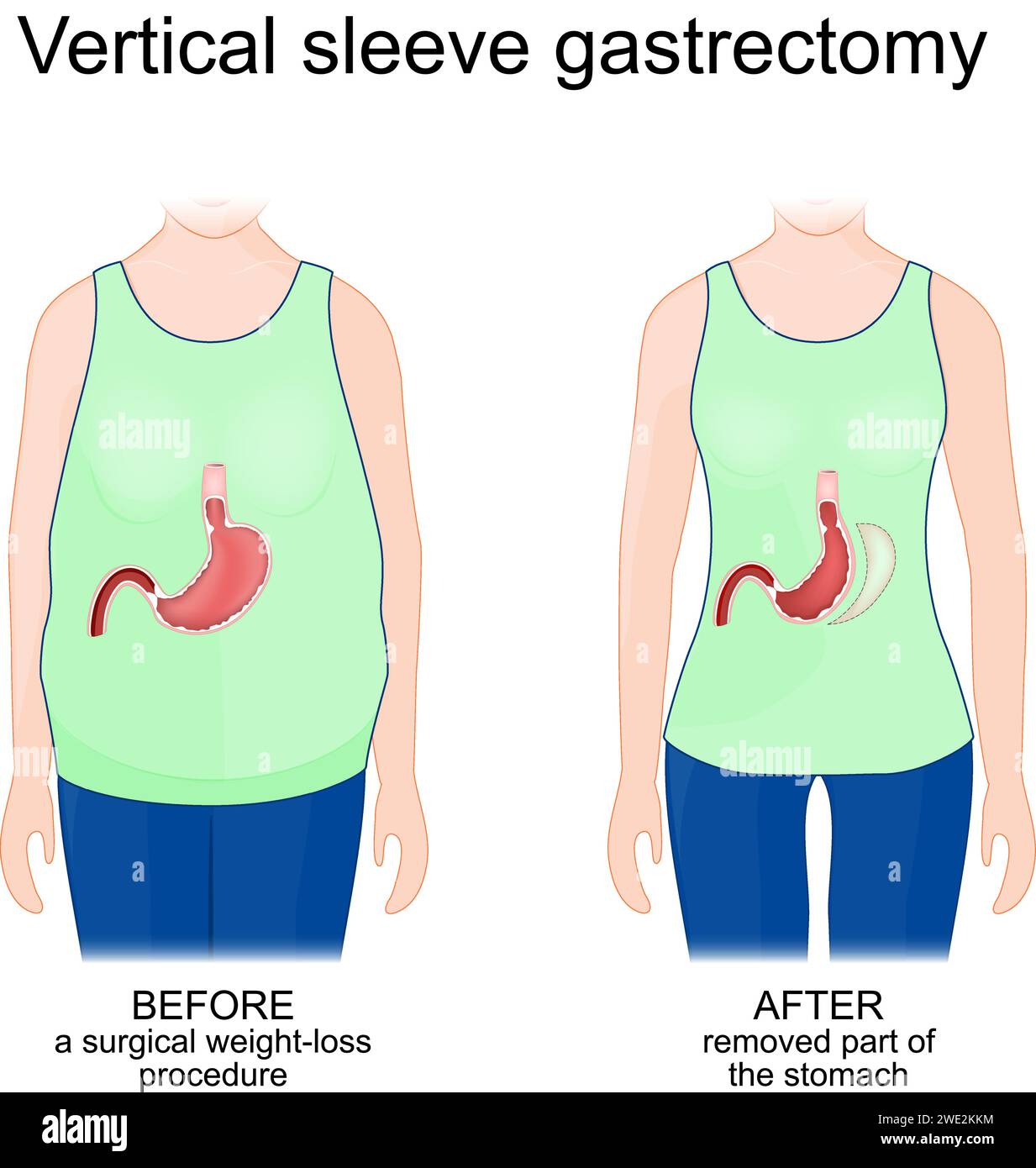 Vertical sleeve gastrectomy. Human body before a surgical weightloss