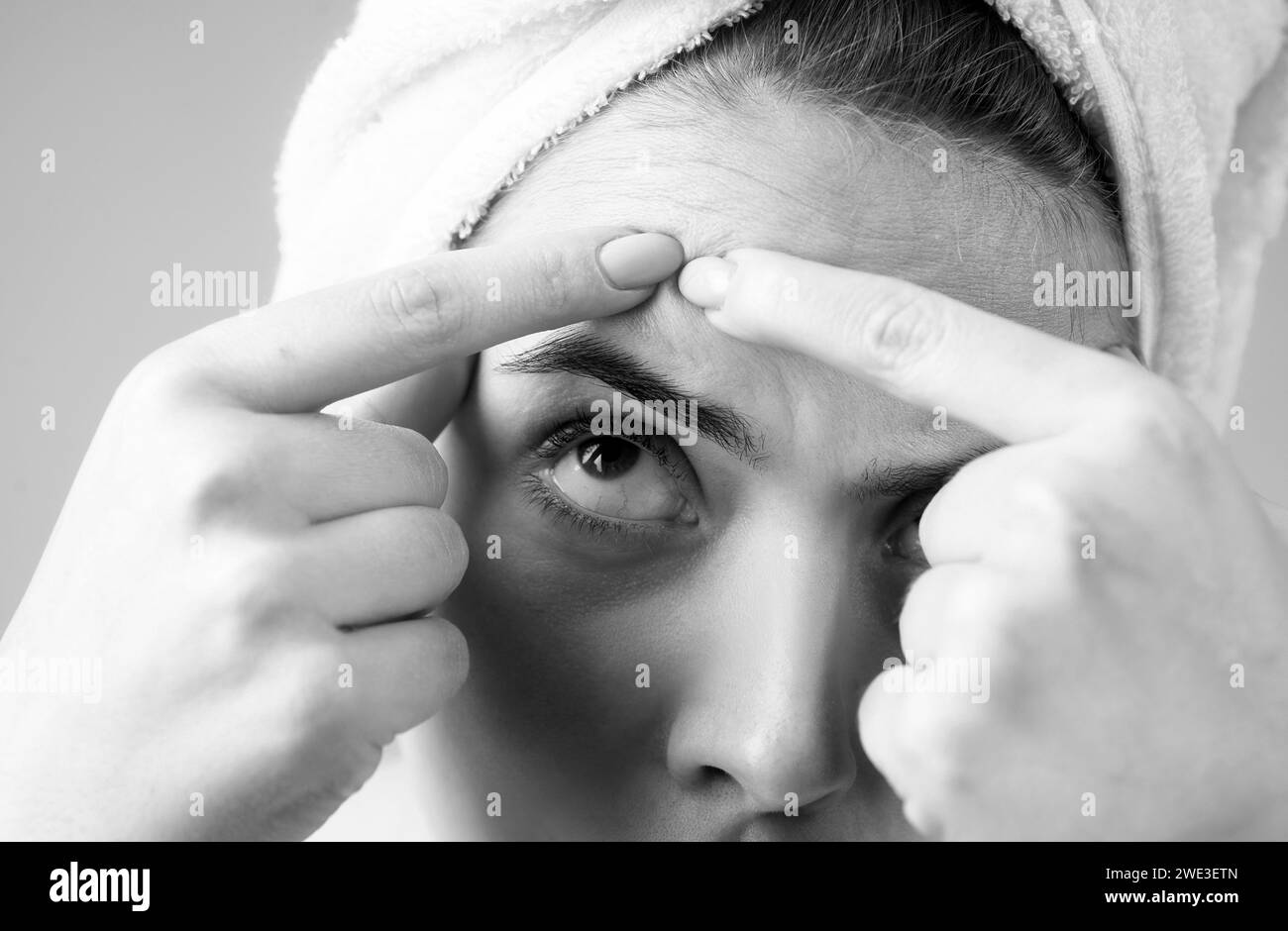 Close up squeezing pimples on her face. Acne blemish spots skin on