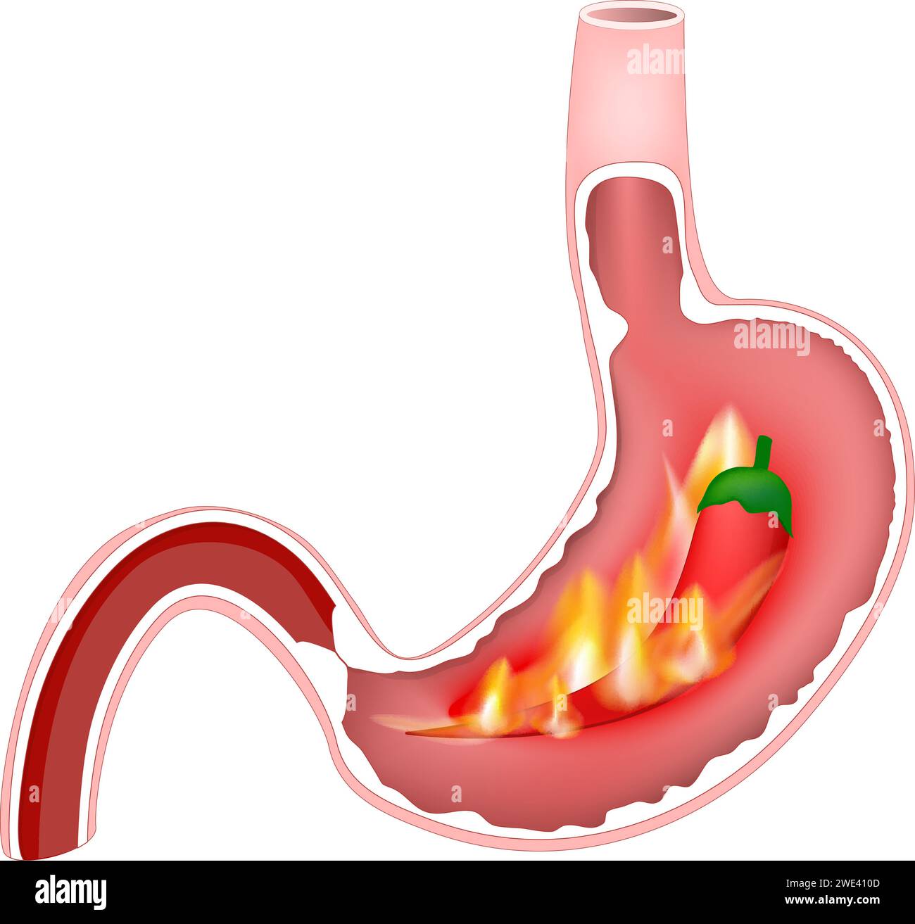 Heartburn of stomach. Cross section of stomach with hot flames and red chili pepper. Pyrosis, cardialgia or acid indigestion. burning sensation in the Stock Vector