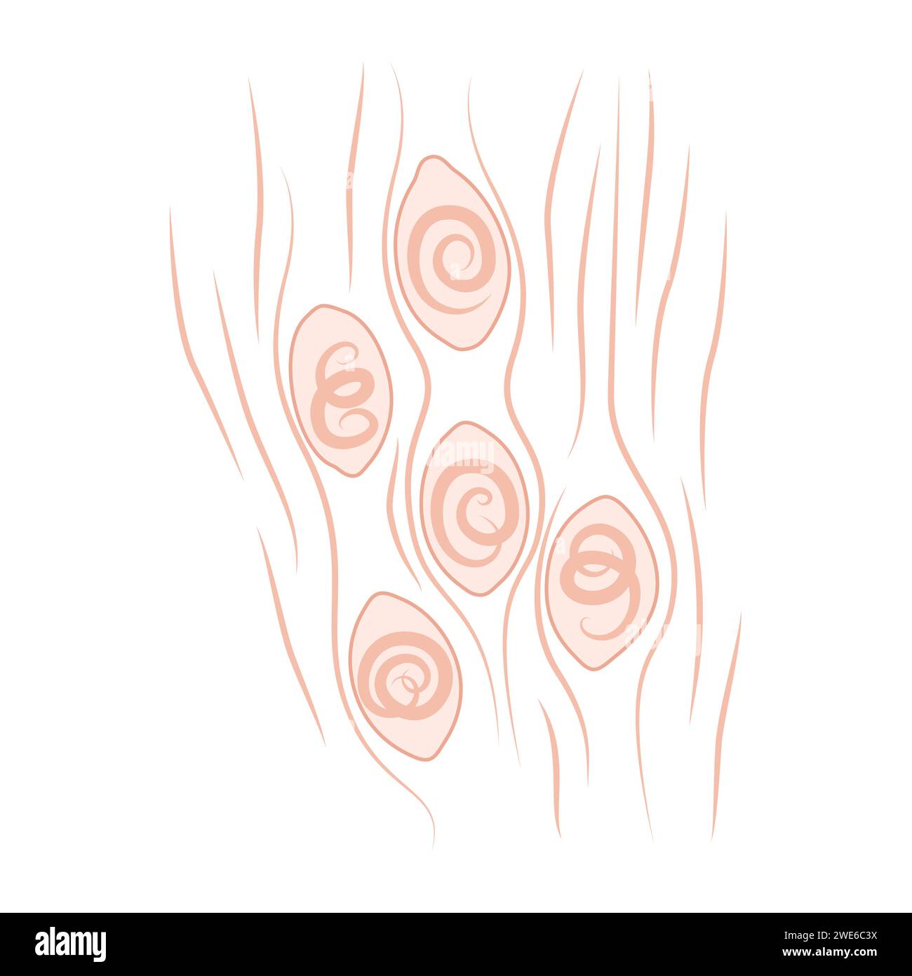 Infection caused by eating of undercooked pork meat infected with parasitic larvae Stock Vector