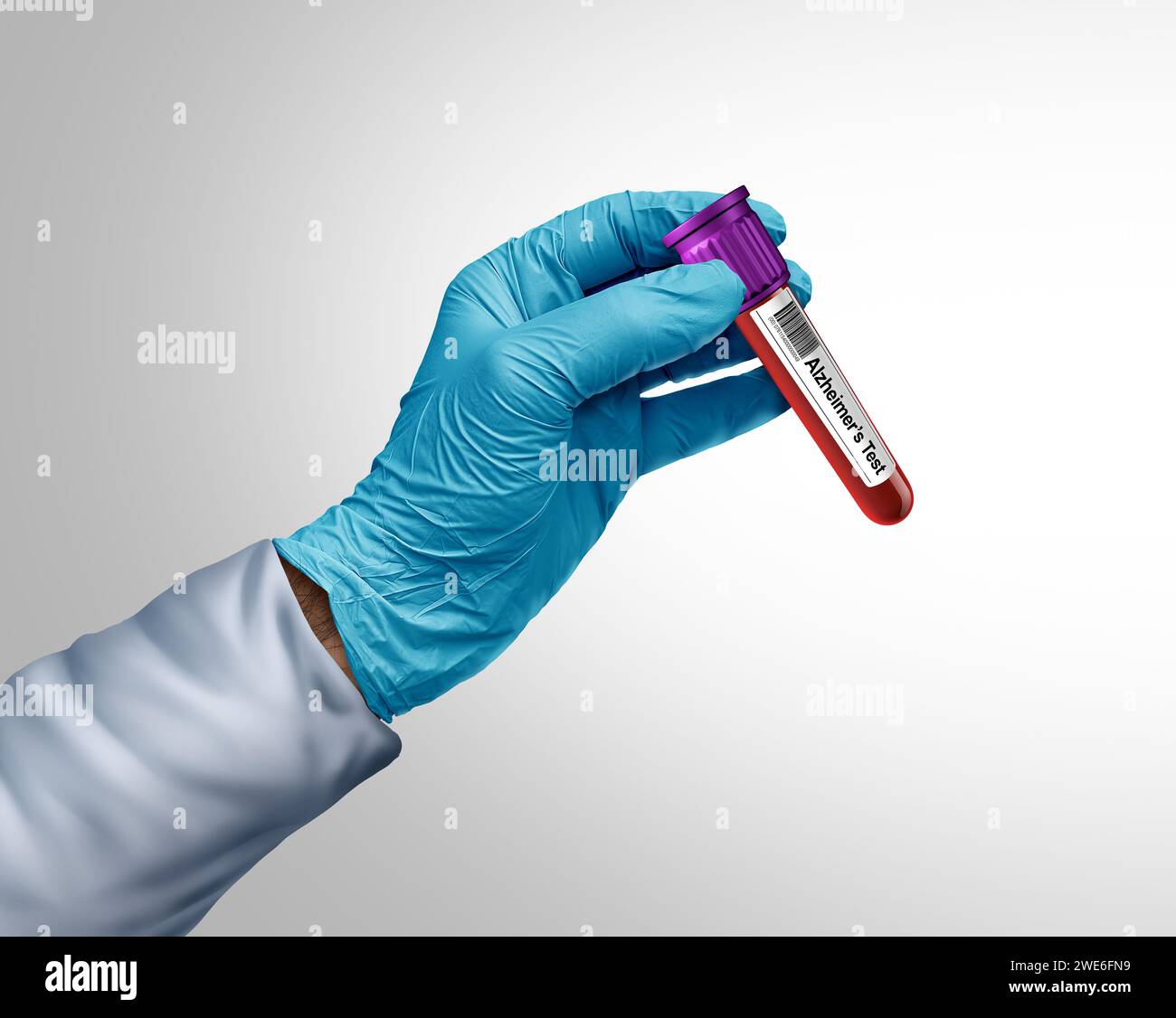 Alzheimers Blood Test Diagnostics and Alzheimer Dementia screening for early detection of brain cognitive health disorders due to amyloid testing Stock Photo