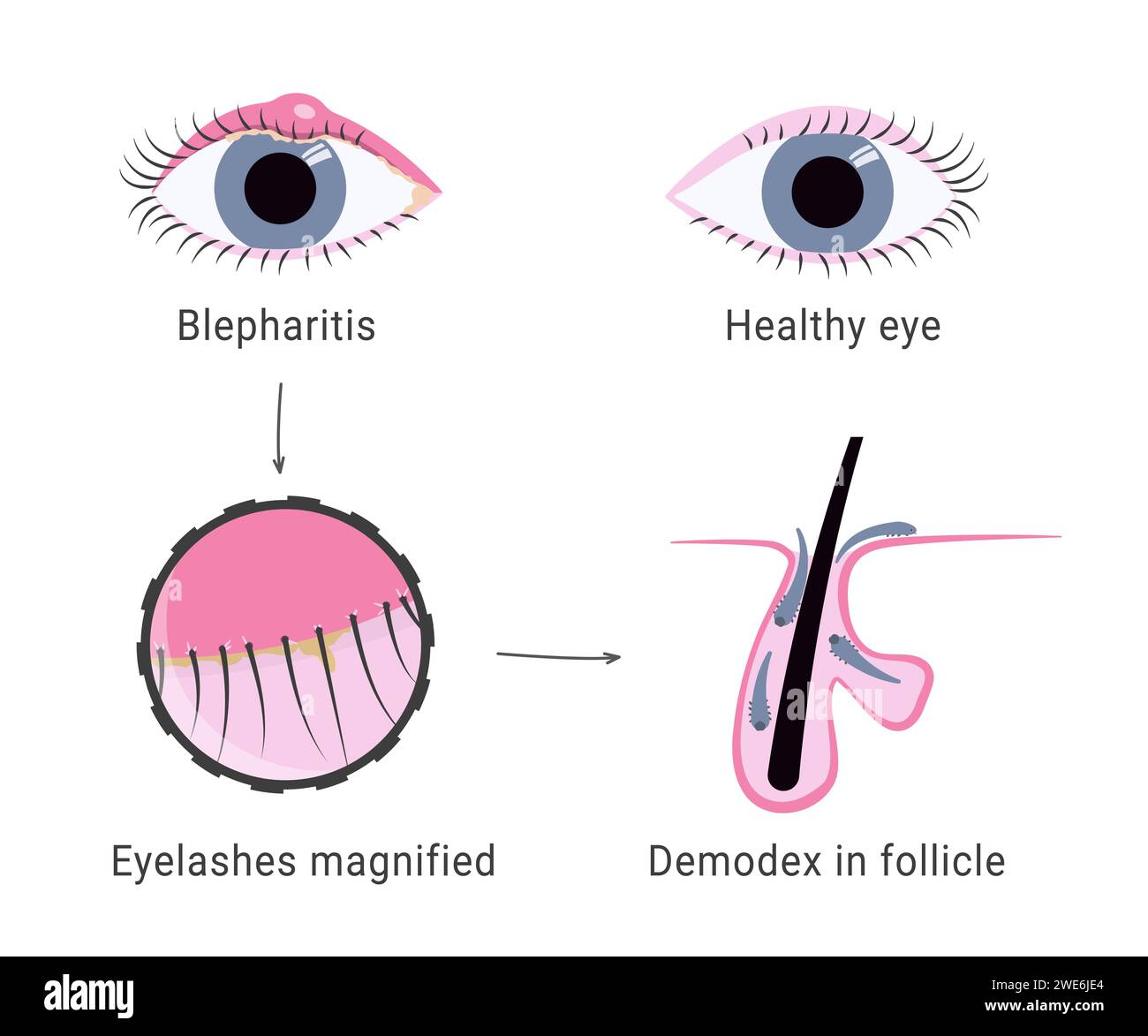 Demodex infection causing blepharitis. Eyelash mites microscope view. Demodex mite in hair follicles of eyelashes. Eyelid swelling.  Stock Vector