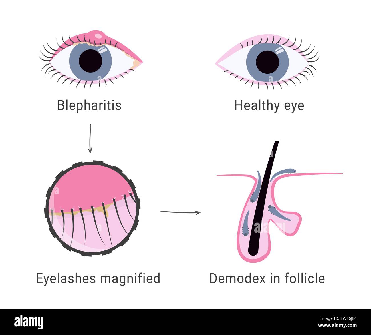 Demodex infection causing blepharitis. Eyelash mites microscope view. Demodex mite in hair