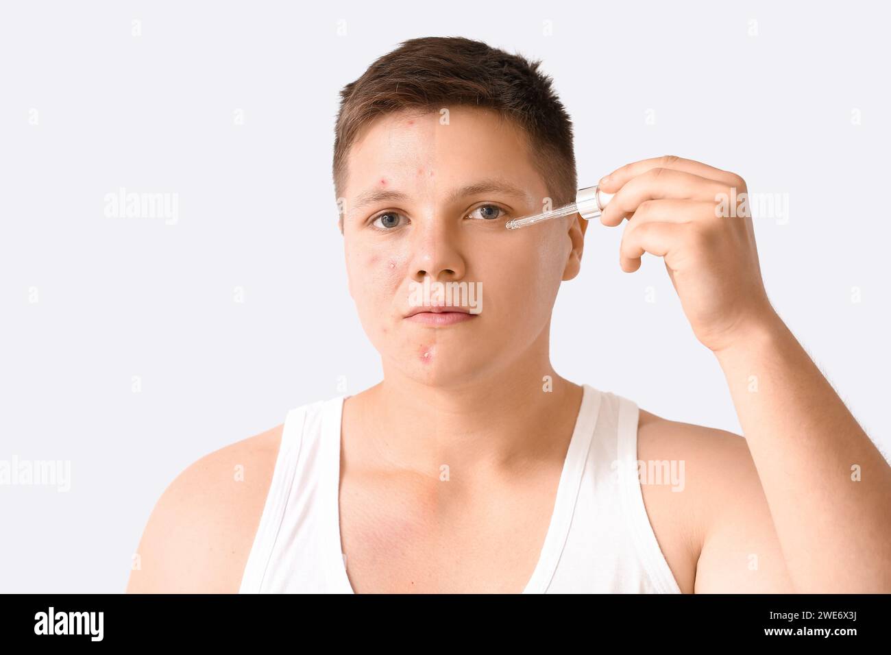 Comparison portrait of teenage boy before and after acne treatment on ...