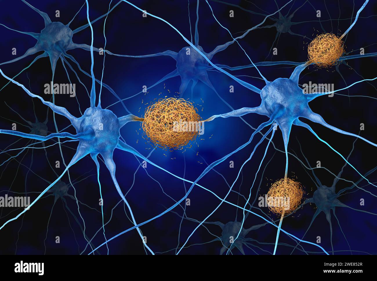 Amyloid Plaques concept as abnormal clusters of protein fragments that accumulate between nerve cells in the brain resulting in degenerative disease Stock Photo