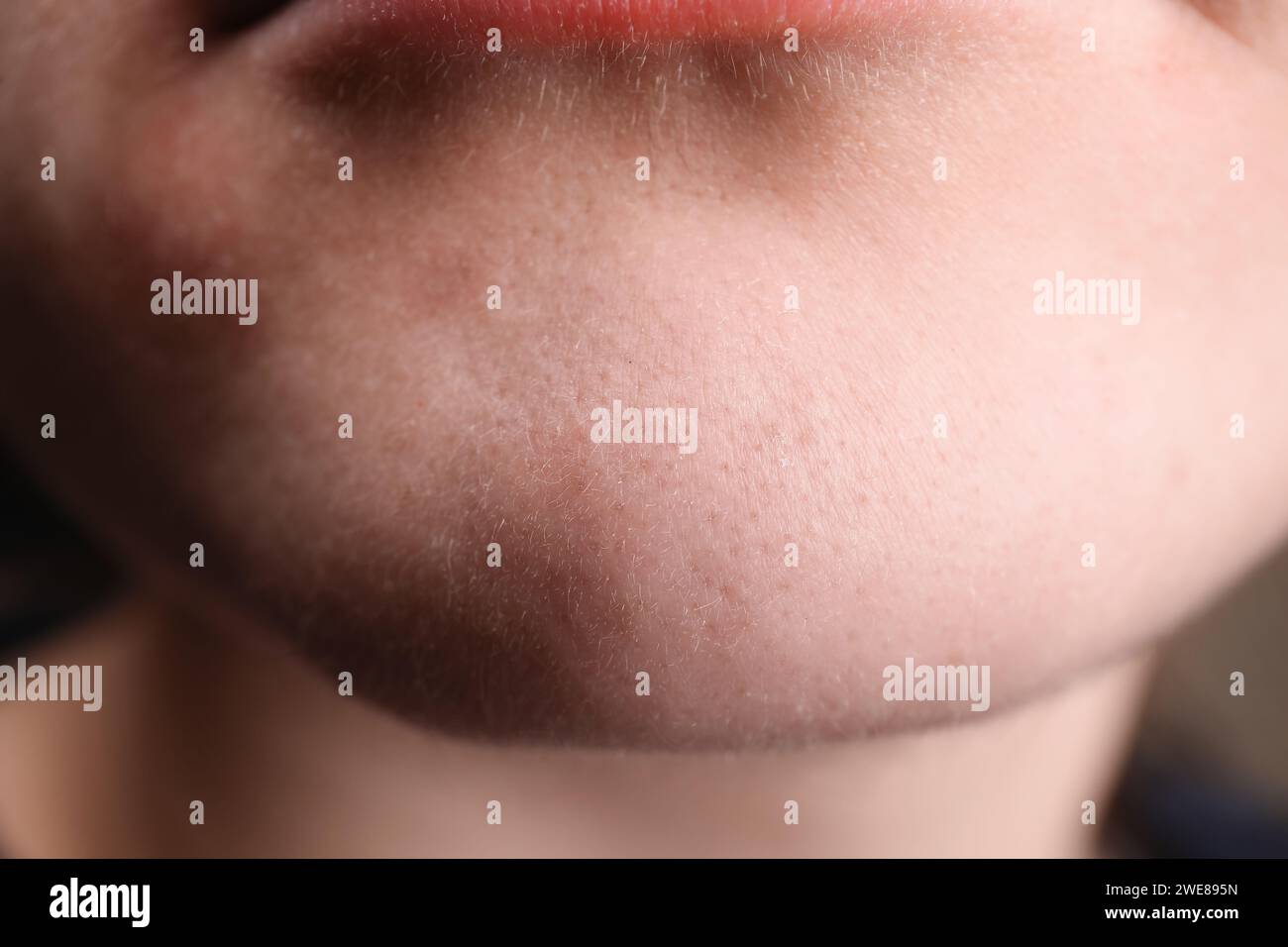Woman with dry skin on chin, closeup Stock Photo Alamy