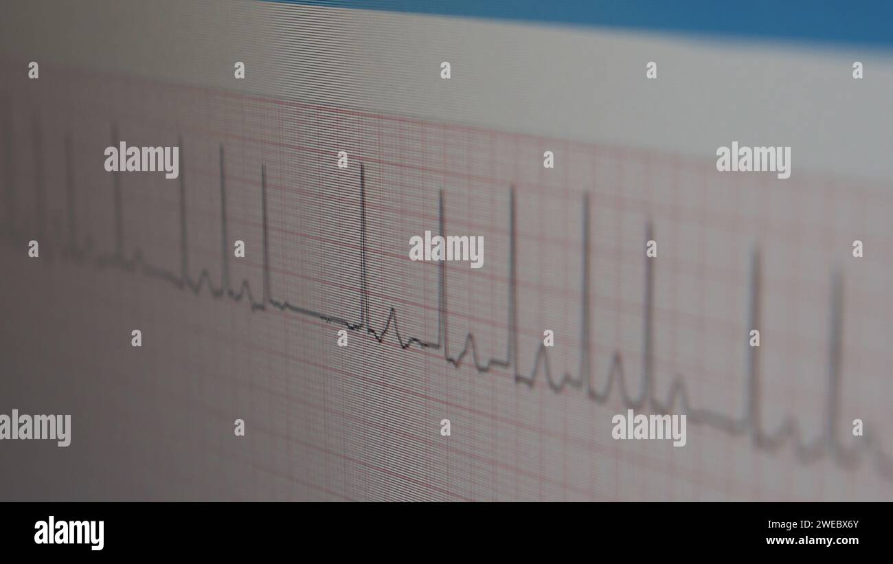 ECG displayed on the LCD screen, close-up Stock Photo