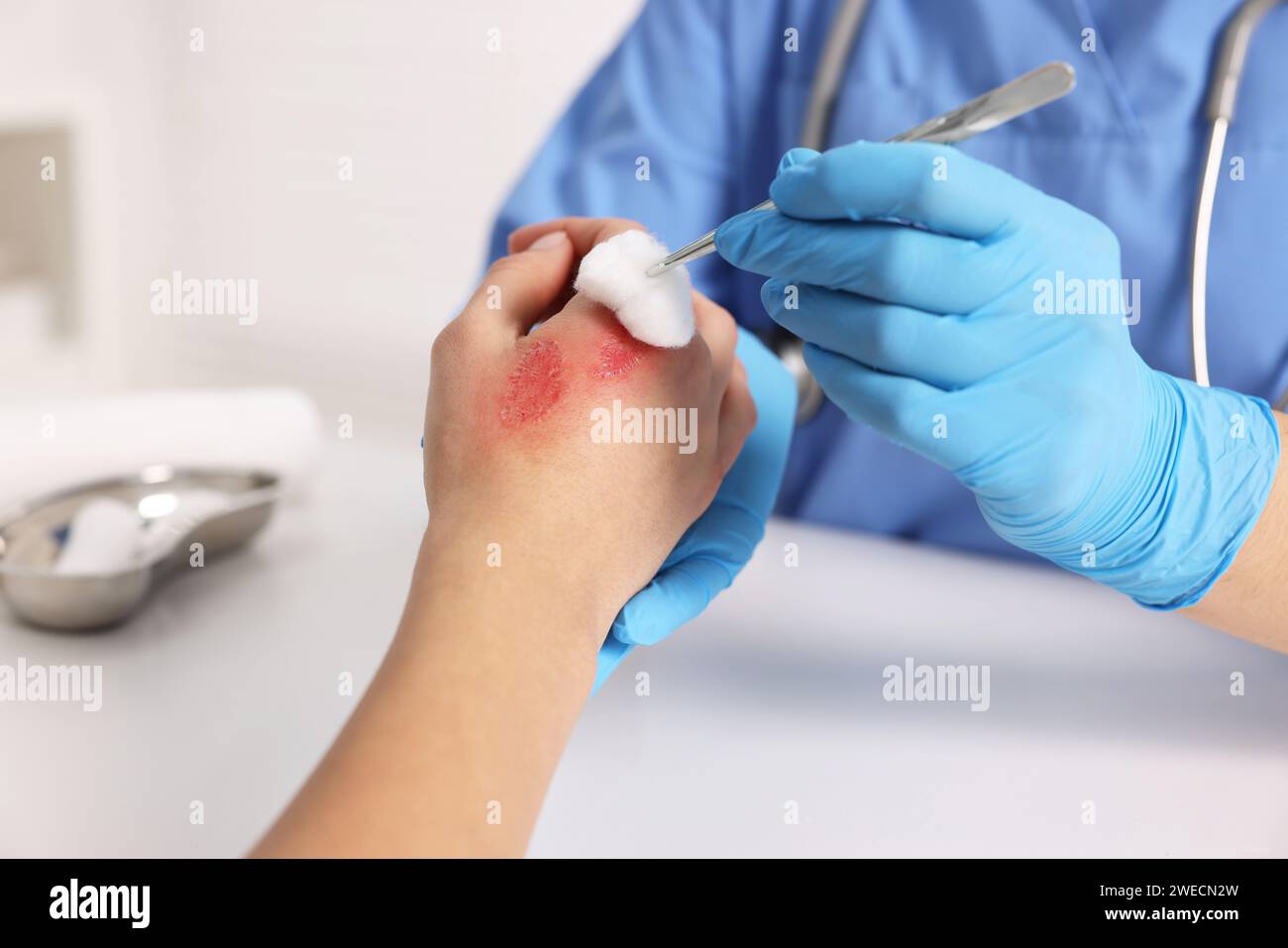 Doctor treating patient's burned hand at table, closeup Stock Photo