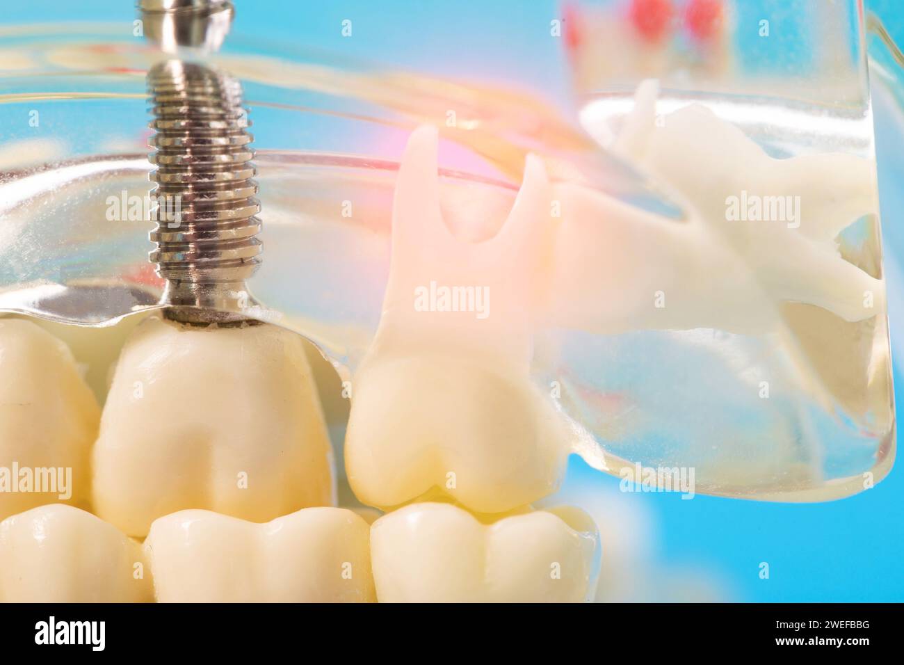 Medical model of a patient's dental jaw with pins in the gums and dental implants. Unerupted wisdom teeth, close-up. Restoration Stock Photo