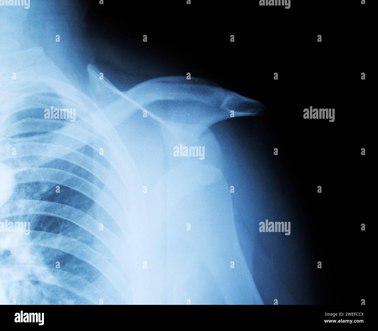 X-ray of a fractured humeral head and shoulder dislocation. Clavicle fracture. Traumatology and orthopedics. Stock Photo