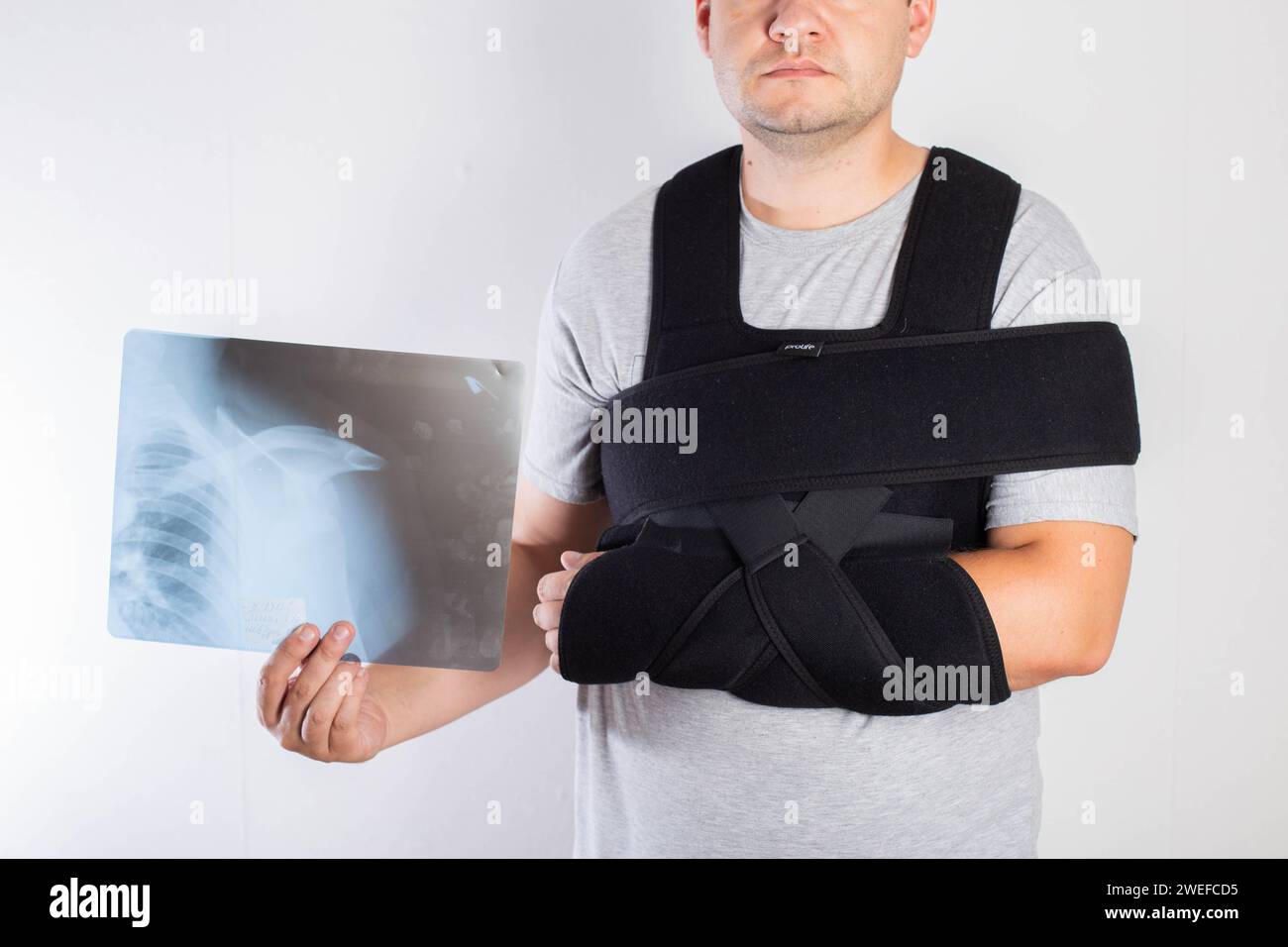 A man in a black bandage supporting the shoulder joint after surgery holds in his hand an x-ray of a dislocated shoulder and a broken arm. Rehabilitat Stock Photo