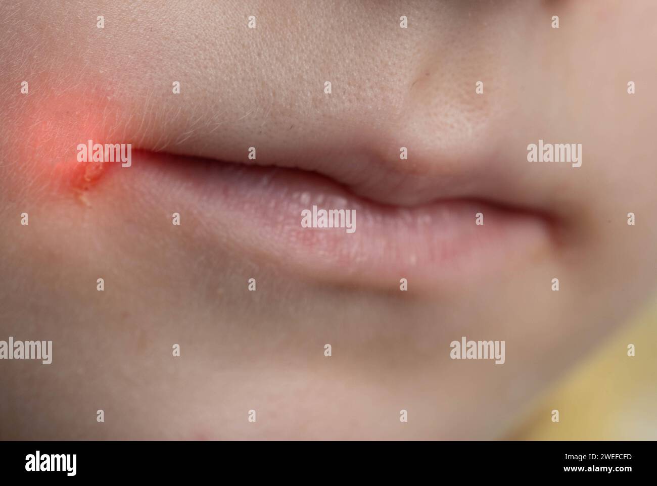 Pain and itching in the corners of the lips of a girl's mouth. Seizures