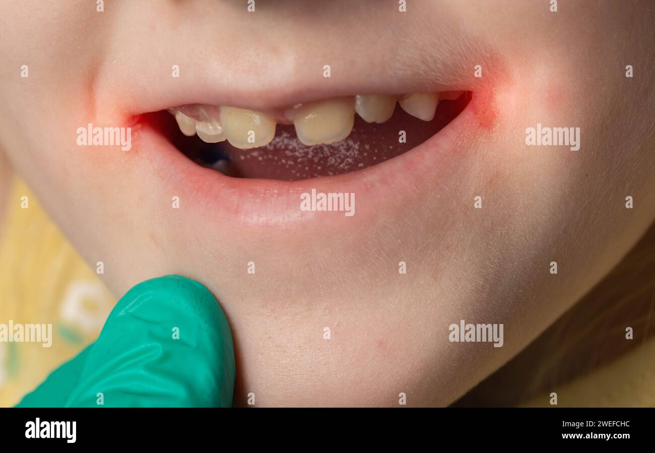 A doctor wearing medical gloves examines the mouth and lip jams of a