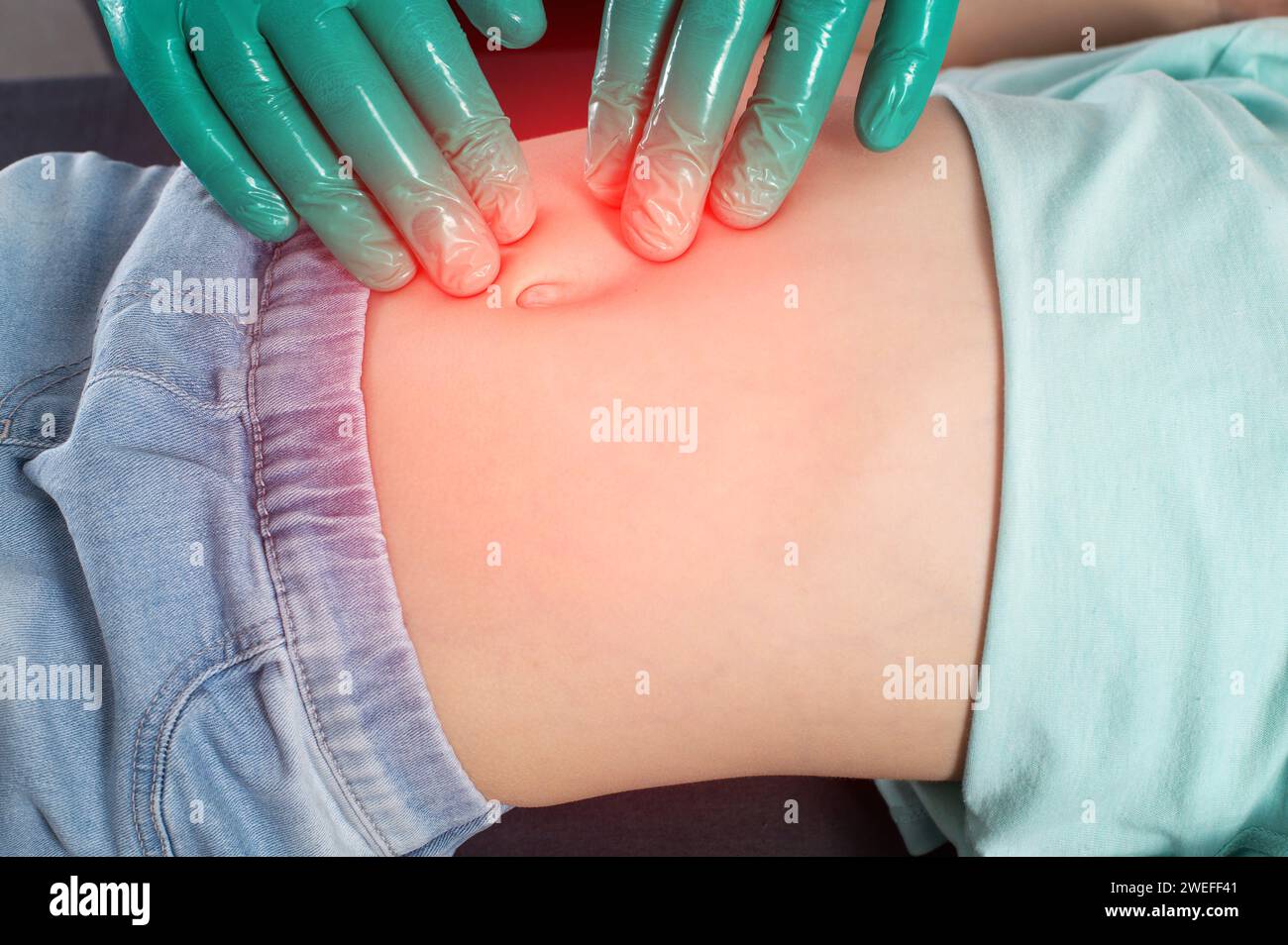 A surgeon doctor palpates the abdomen of the peri-umbilical zone during an abdominal hernia in a little girl. The concept of an extended umbilical rin Stock Photo