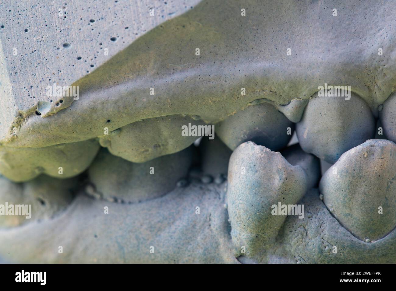 Blue plaster impression of the dental jaw of a patient with crooked