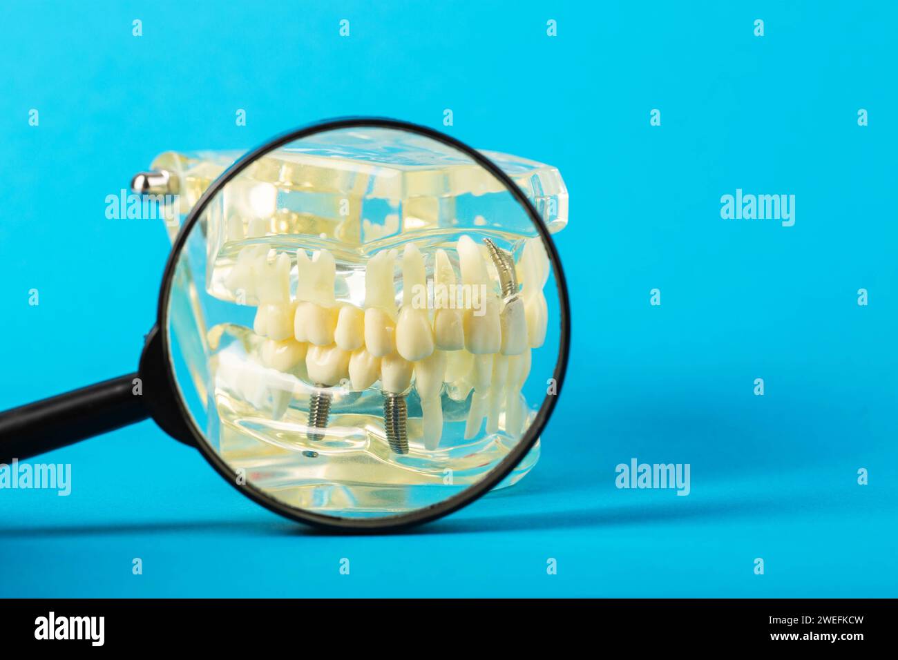 Medical mockup of a dental jaw under a magnifying glass on a blue background. The concept of dental pins for the installation of crowns and dental pro Stock Photo