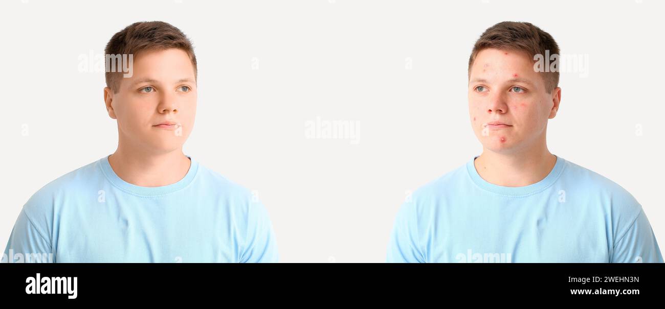 Teenage boy before and after acne treatment on white background Stock ...