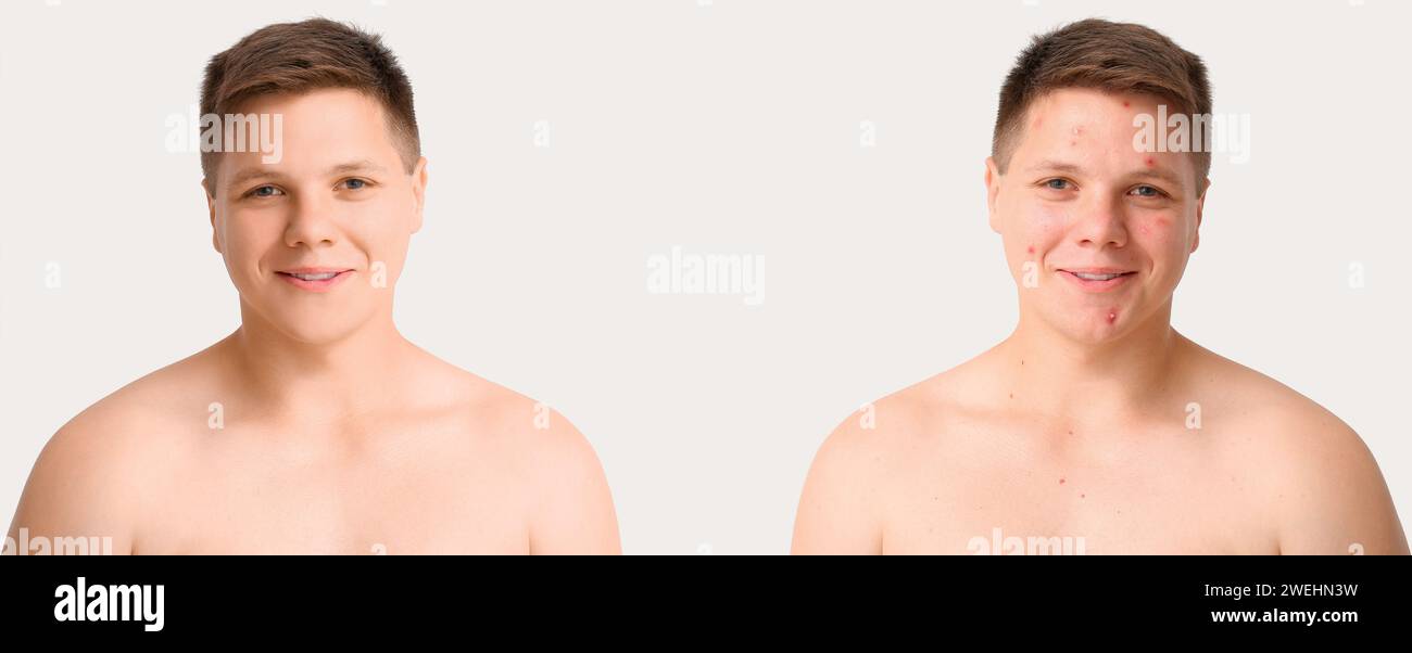 Teenage boy before and after acne treatment on white background Stock ...