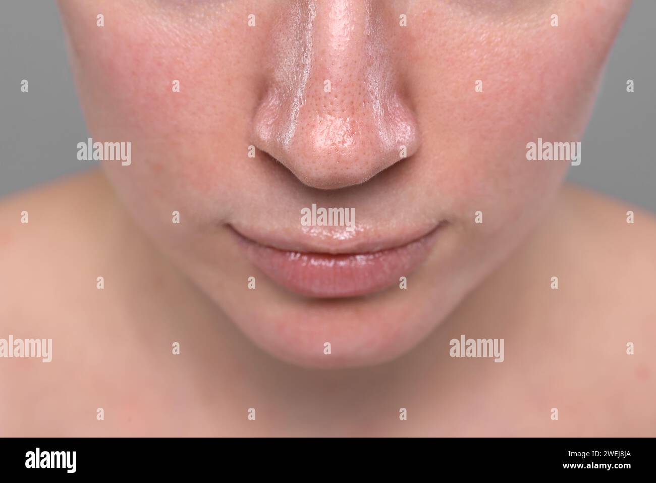 Closeup view of woman with reddened skin on grey background Stock Photo