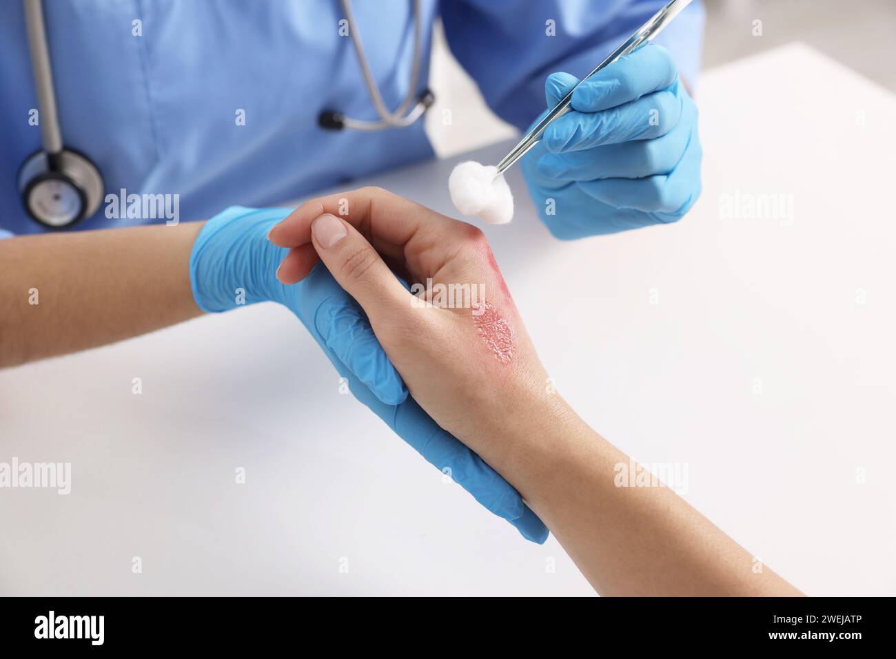 Doctor treating patient's burned hand at table, closeup Stock Photo