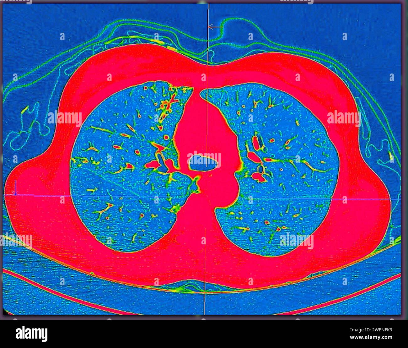 Ct Scan Of Chest Axial View In Color Mode For Diagnostic Pulmonary Embolism Pe Lung Cancer 9689