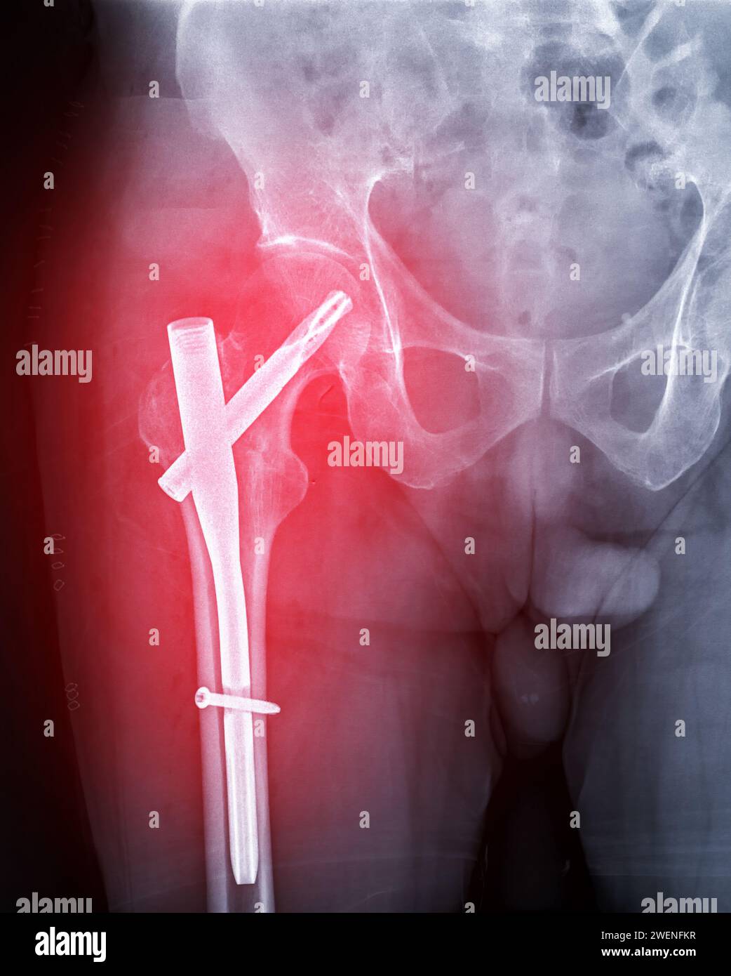 An Xray reveals both hip joints with hemiarthroplasty, showcasing the