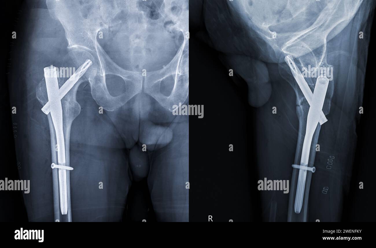 An X-ray reveals both hip joints with hemiarthroplasty, showcasing the success of the surgical procedure and providing a visual testament to the resto Stock Photo