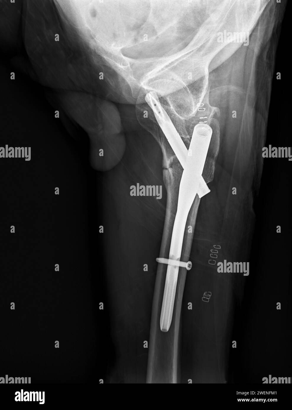 An Xray reveals both hip joints with hemiarthroplasty, showcasing the
