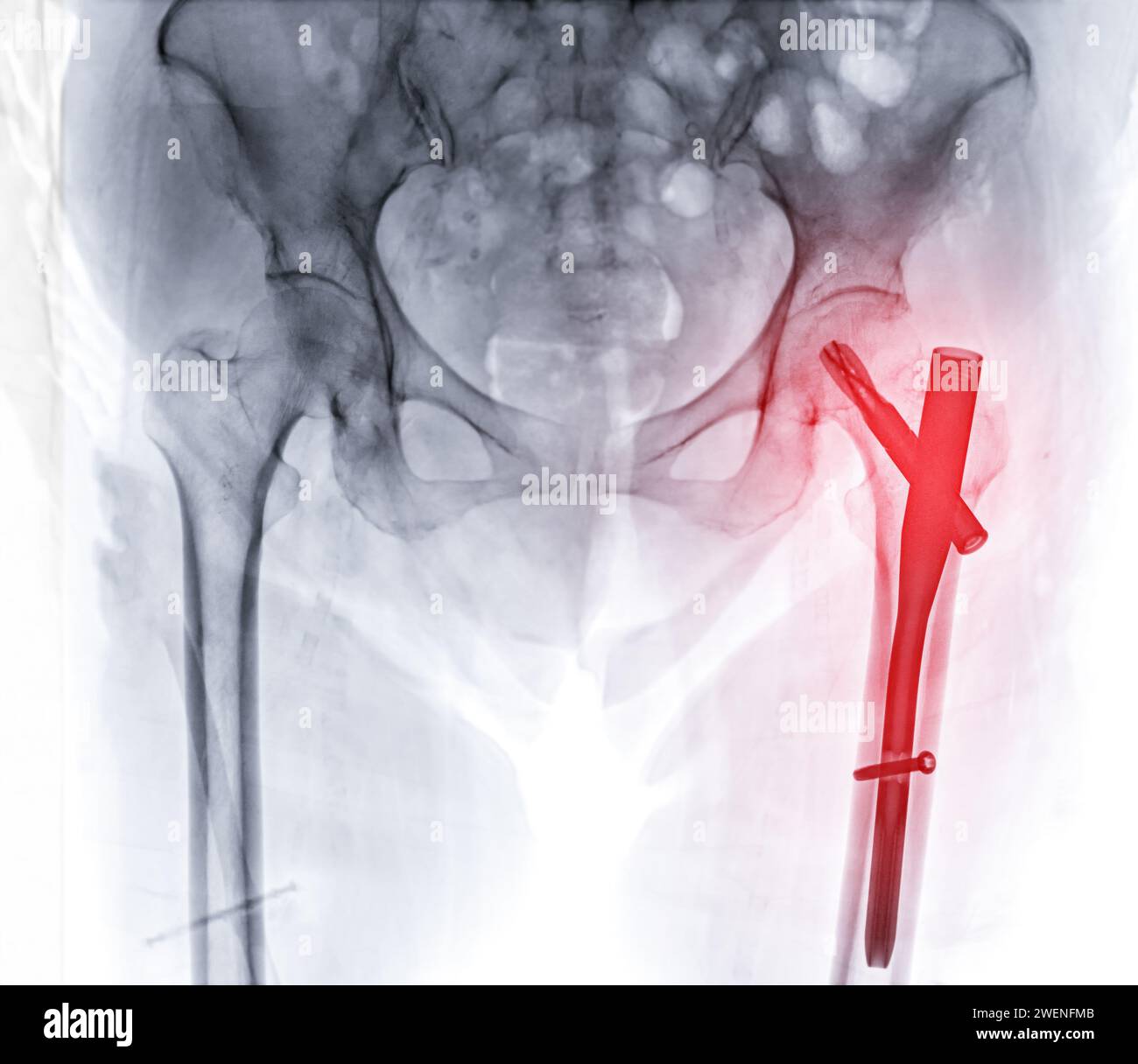 An X-ray reveals both hip joints with hemiarthroplasty, showcasing the success of the surgical procedure and providing a visual testament to the resto Stock Photo