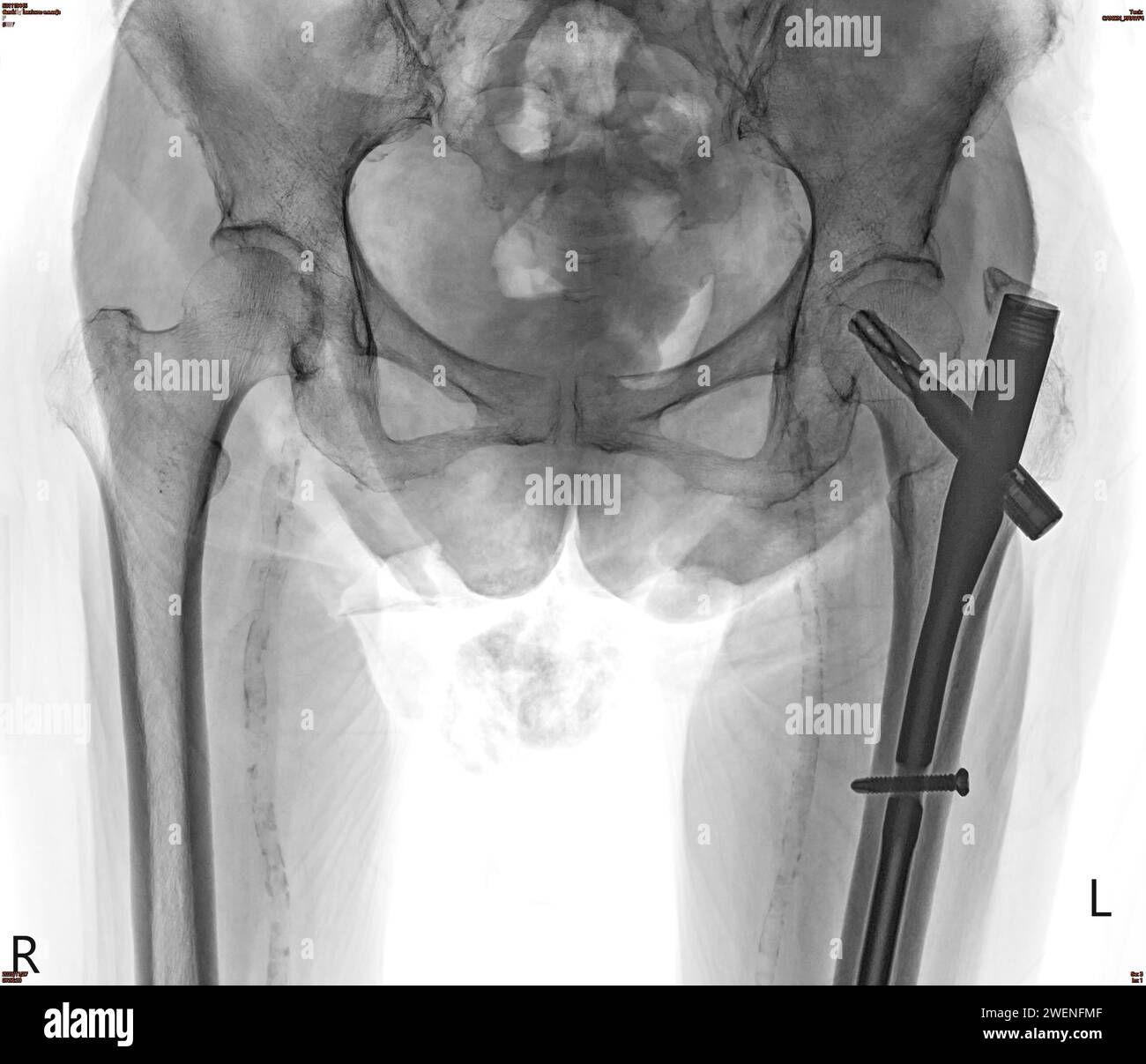 An Xray reveals both hip joints with hemiarthroplasty, showcasing the