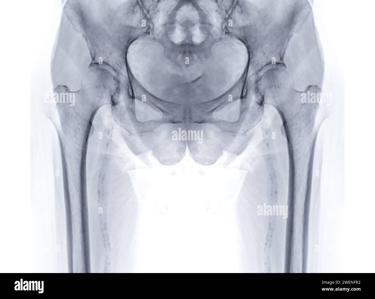 An X-ray reveals both hip joints with prosthetic replacements, showcasing the success of the surgical procedure and providing a visual testament to th Stock Photo