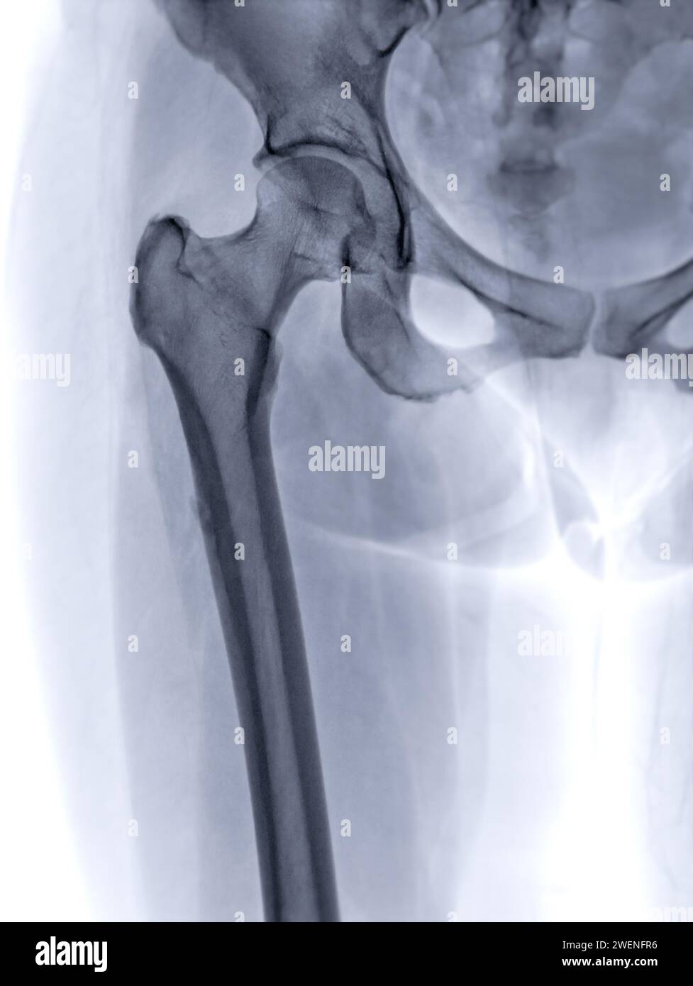 An X-ray reveals both hip joints in normal study. Stock Photo