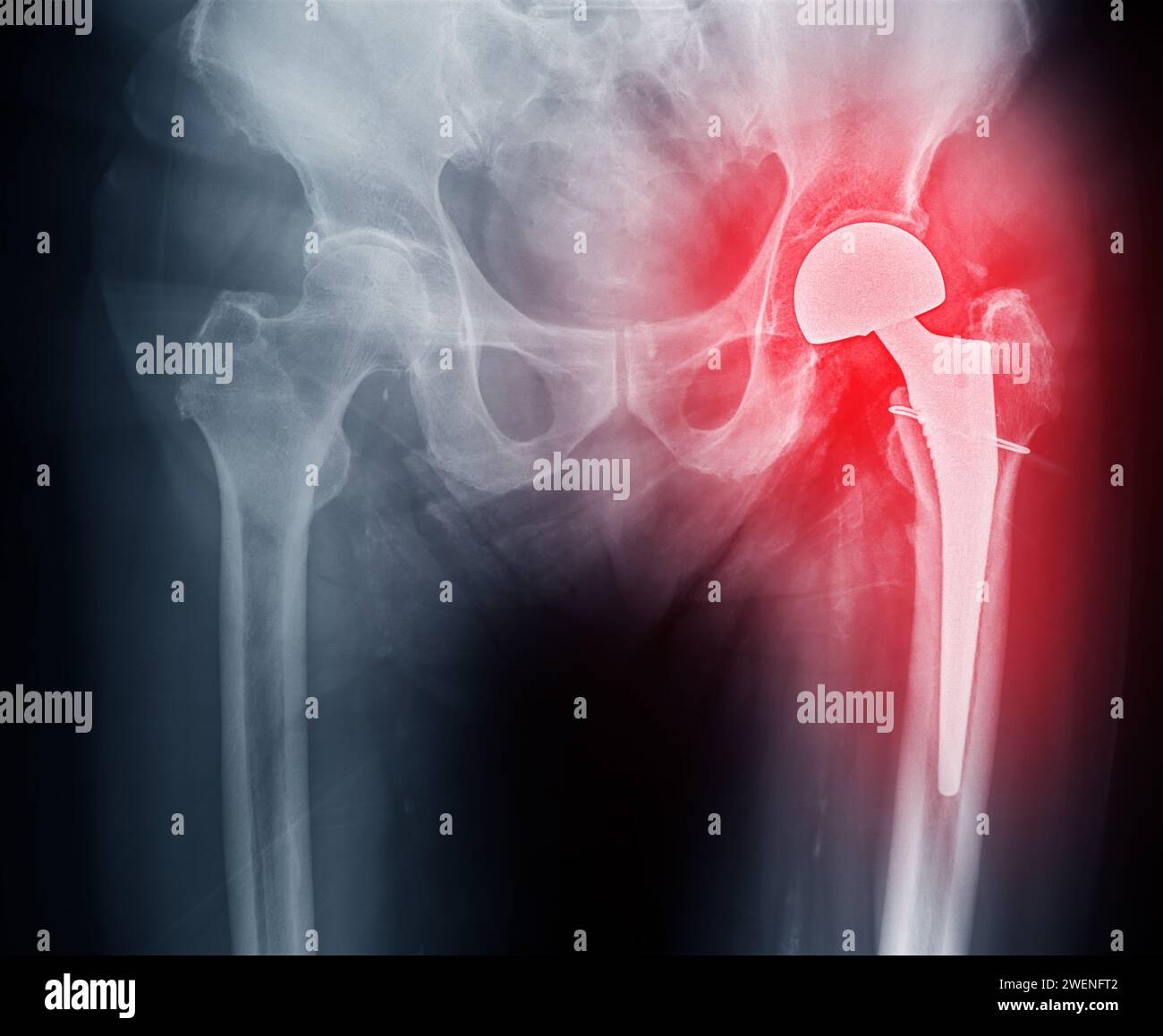 An X-ray reveals both hip joints with TOTAL HIP ARTHROPLASTY, showcasing the success of the surgical procedure and providing a visual testament to the Stock Photo