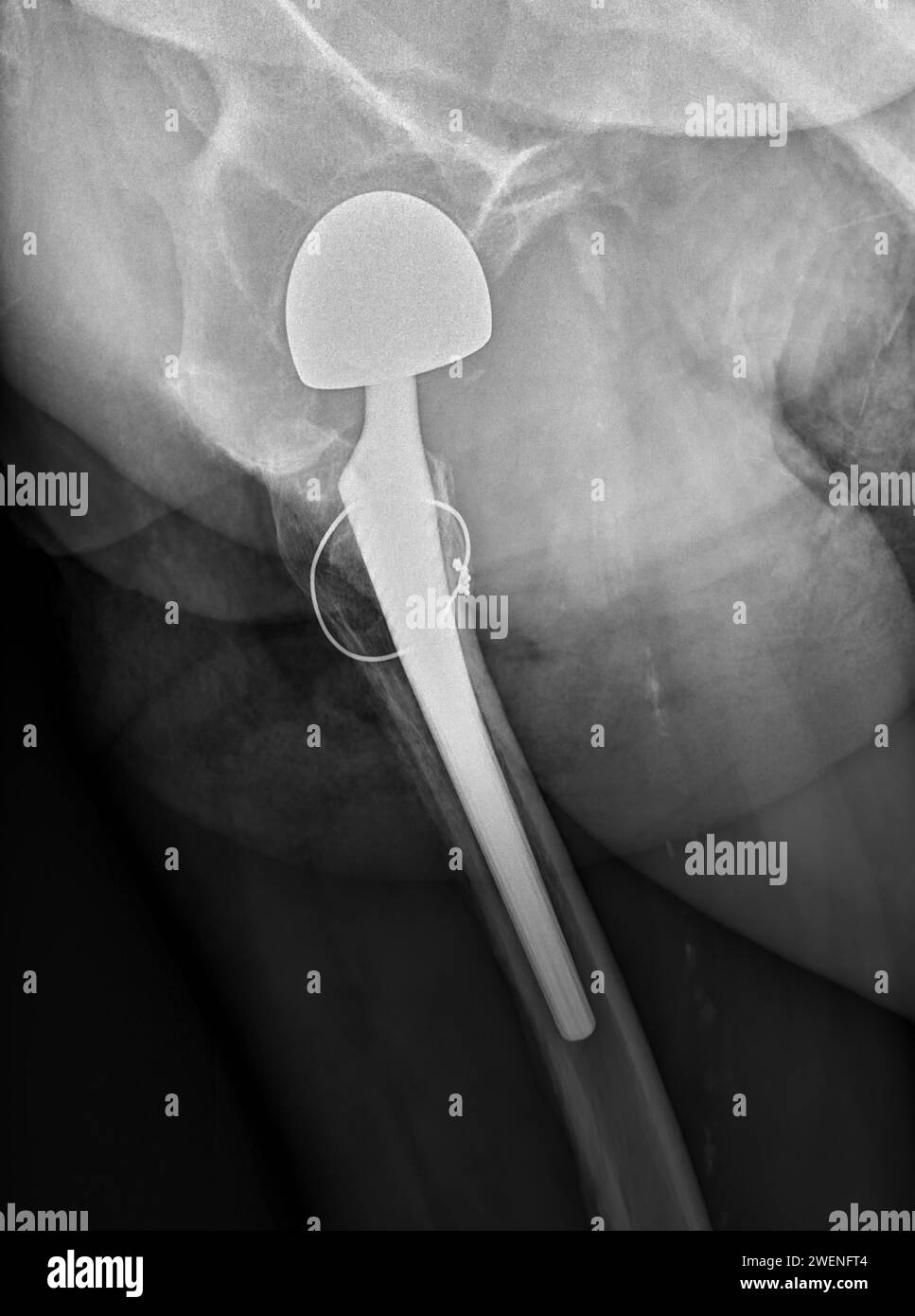 An Xray reveals both hip joints with TOTAL HIP ARTHROPLASTY