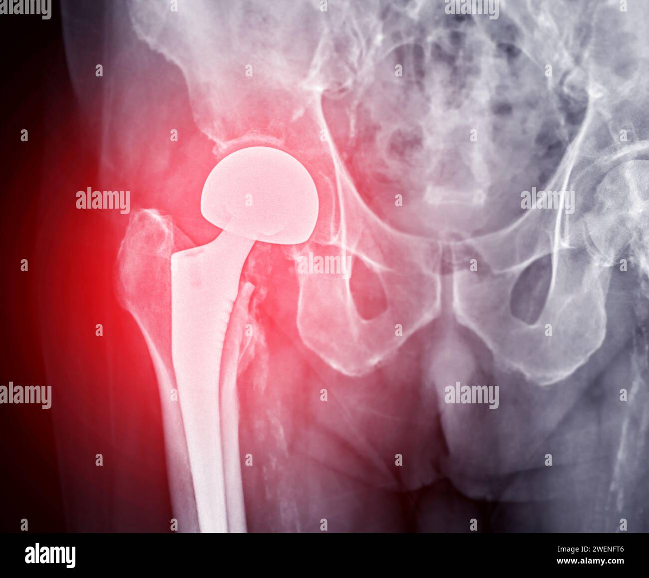 An X Ray Reveals Both Hip Joints With Total Hip Arthroplasty Showcasing The Success Of The