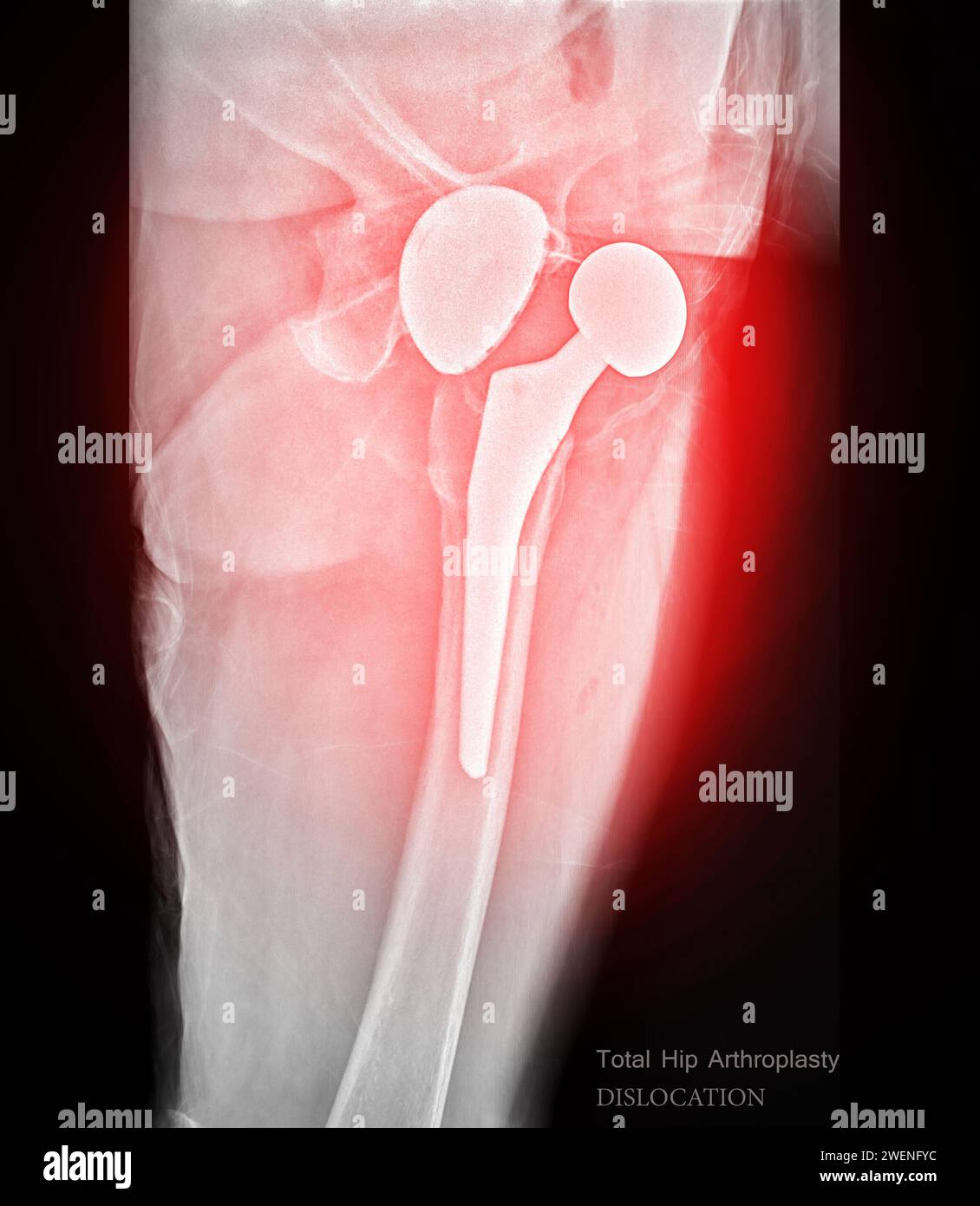 An X-ray reveals both hip joints with prosthetic replacements, showcasing Dislocation of prosthetic replacements. Stock Photo