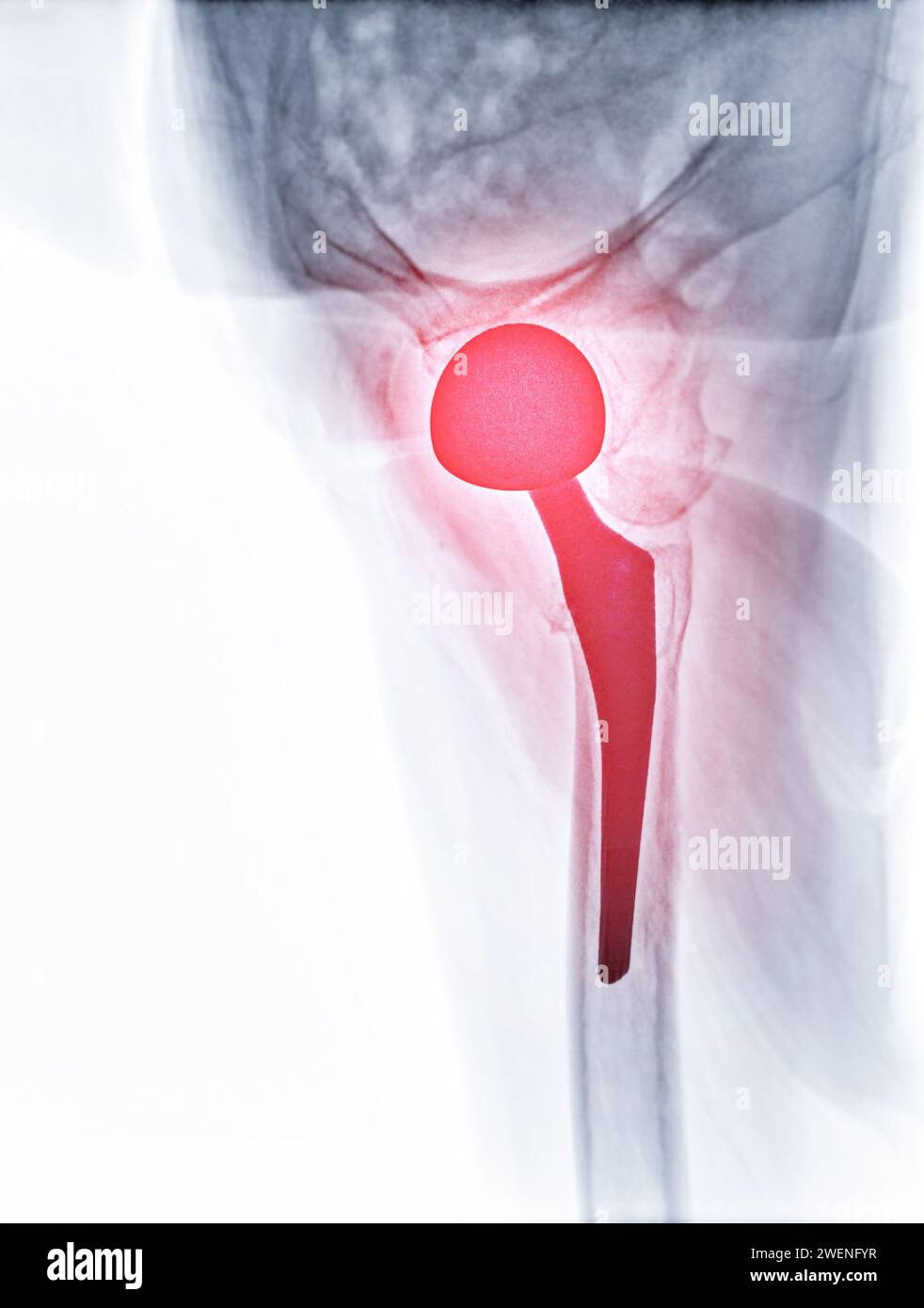 An X-ray reveals both hip joints with TOTAL HIP ARTHROPLASTY, showcasing the success of the surgical procedure and providing a visual testament to the Stock Photo