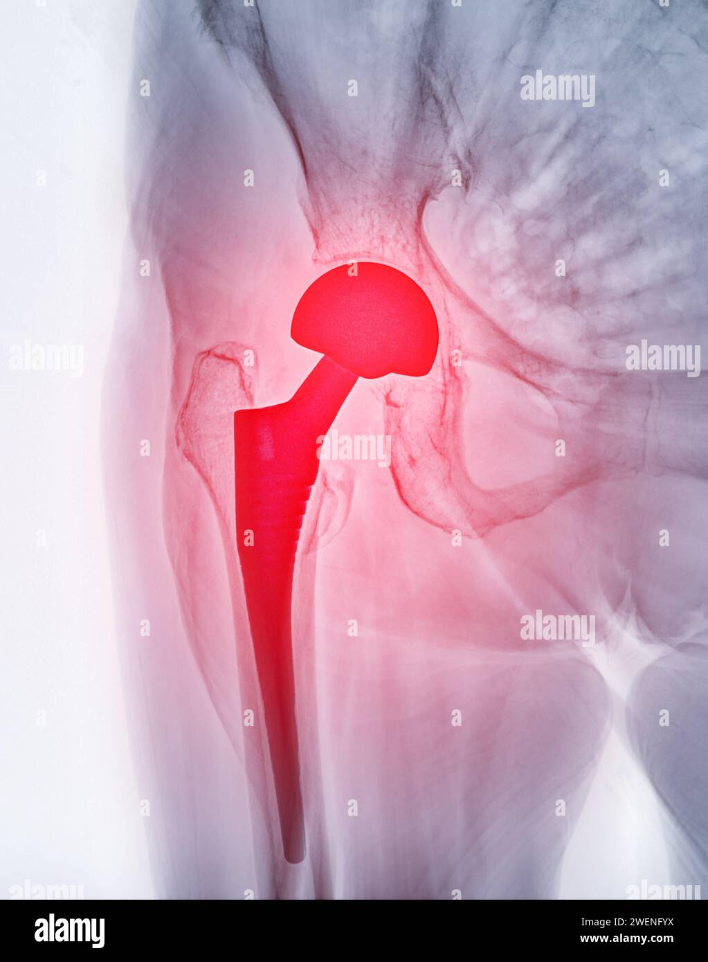 An X-ray reveals both hip joints with TOTAL HIP ARTHROPLASTY, showcasing the success of the surgical procedure and providing a visual testament to the Stock Photo