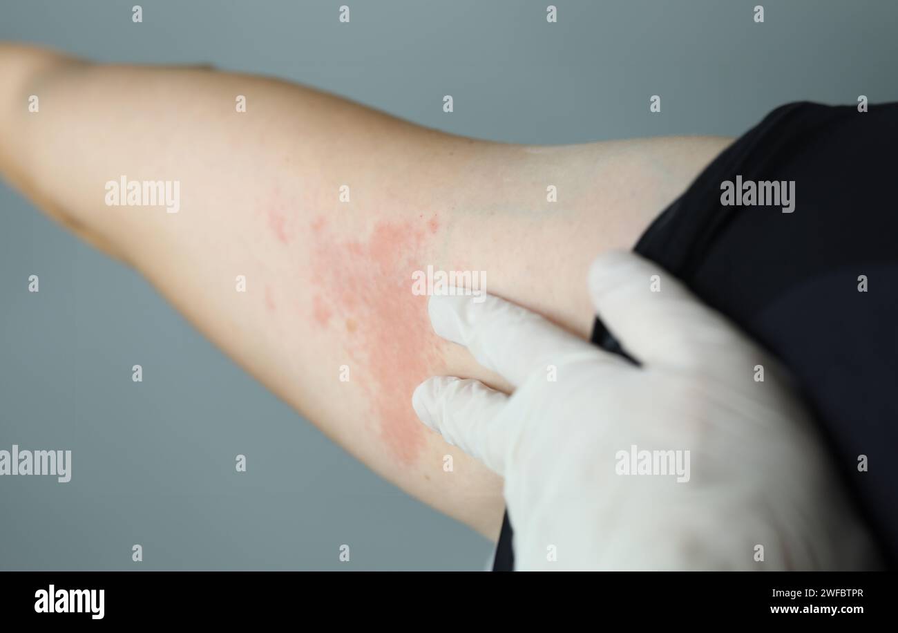 Close-up red rash on white skin hand, examination Stock Photo - Alamy