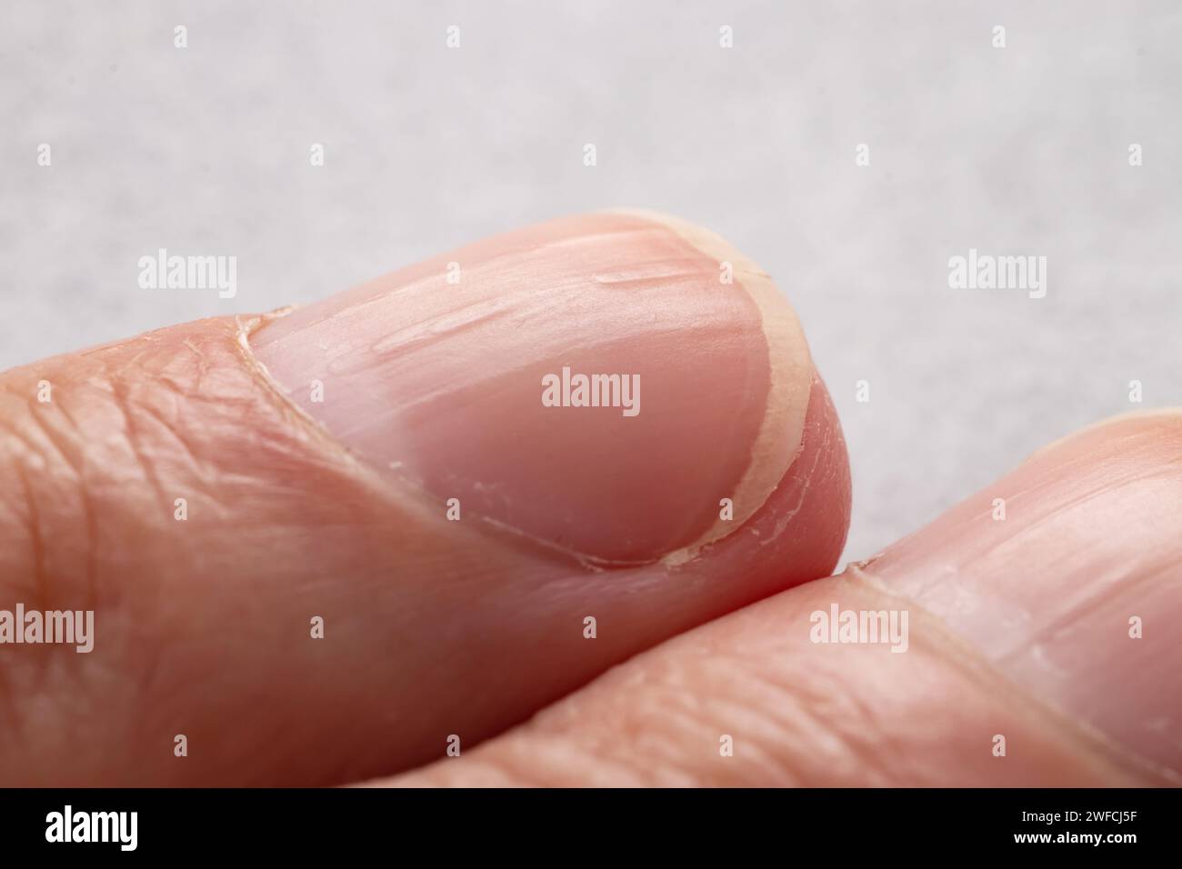 Ridged fingernails with vertical ridges.Nails problems Stock Photo Alamy